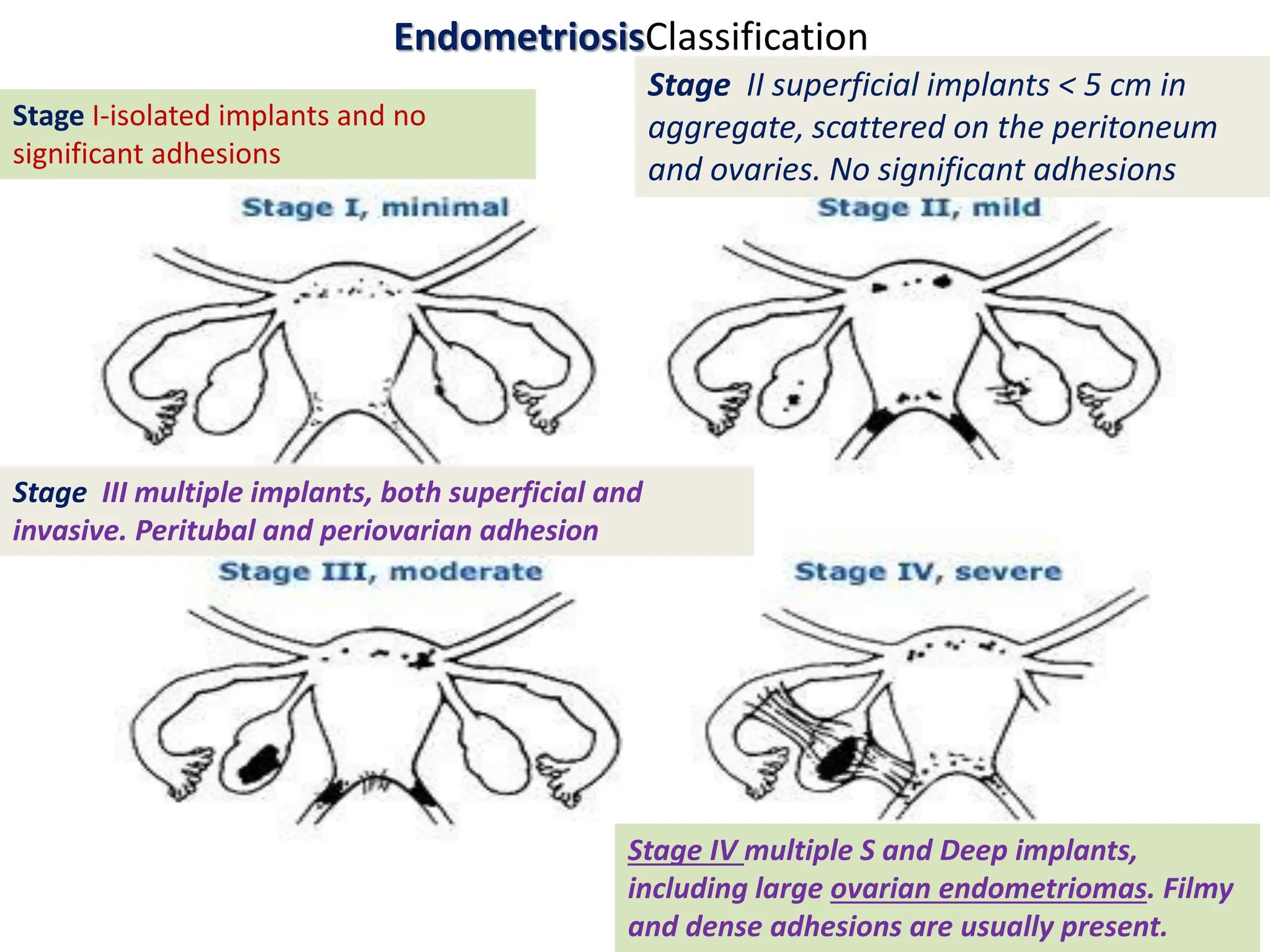 EndometriosisClassification
Stage I-isolated implants and no
significant adhesions
Stage II superficial implants < 5 cm in
aggregate, scattered on the peritoneum
and ovaries. No significant adhesions
Stage III multiple implants, both superficial and
invasive. Peritubal and periovarian adhesion
Stage IV multiple S and Deep implants,
including large ovarian endometriomas. Filmy
and dense adhesions are usually present.
 