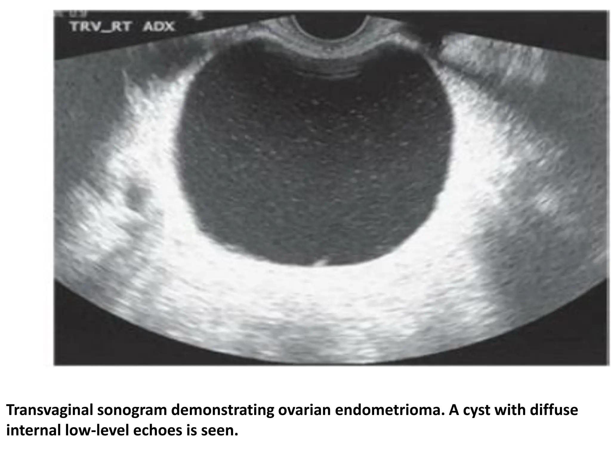 Transvaginal sonogram demonstrating ovarian endometrioma. A cyst with diffuse
internal low-level echoes is seen.
 