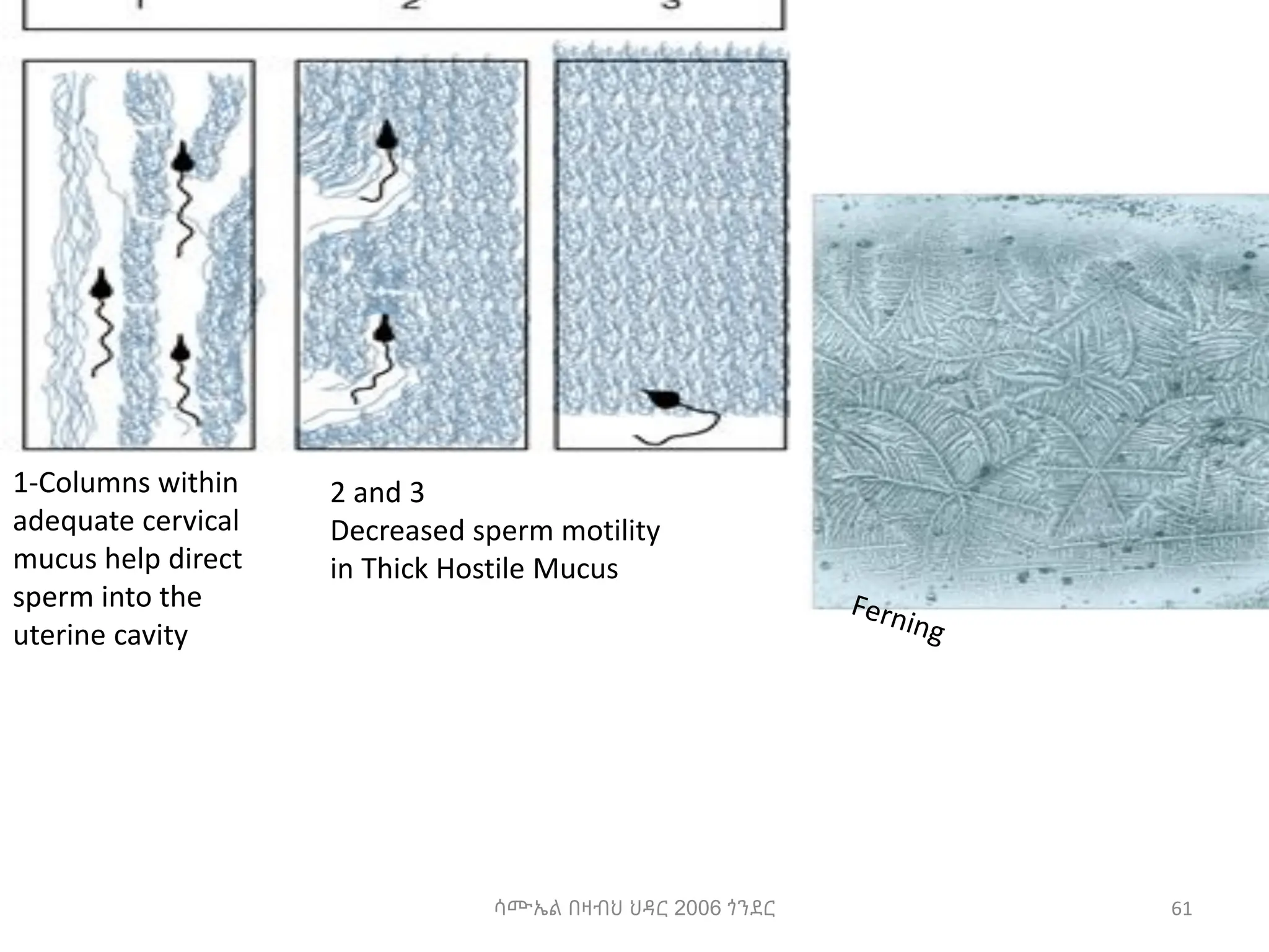 ሳሙኤል በዛብህ ህዳር 2006 ጎንደር 61
2 and 3
Decreased sperm motility
in Thick Hostile Mucus
1-Columns within
adequate cervical
mucus help direct
sperm into the
uterine cavity
 
