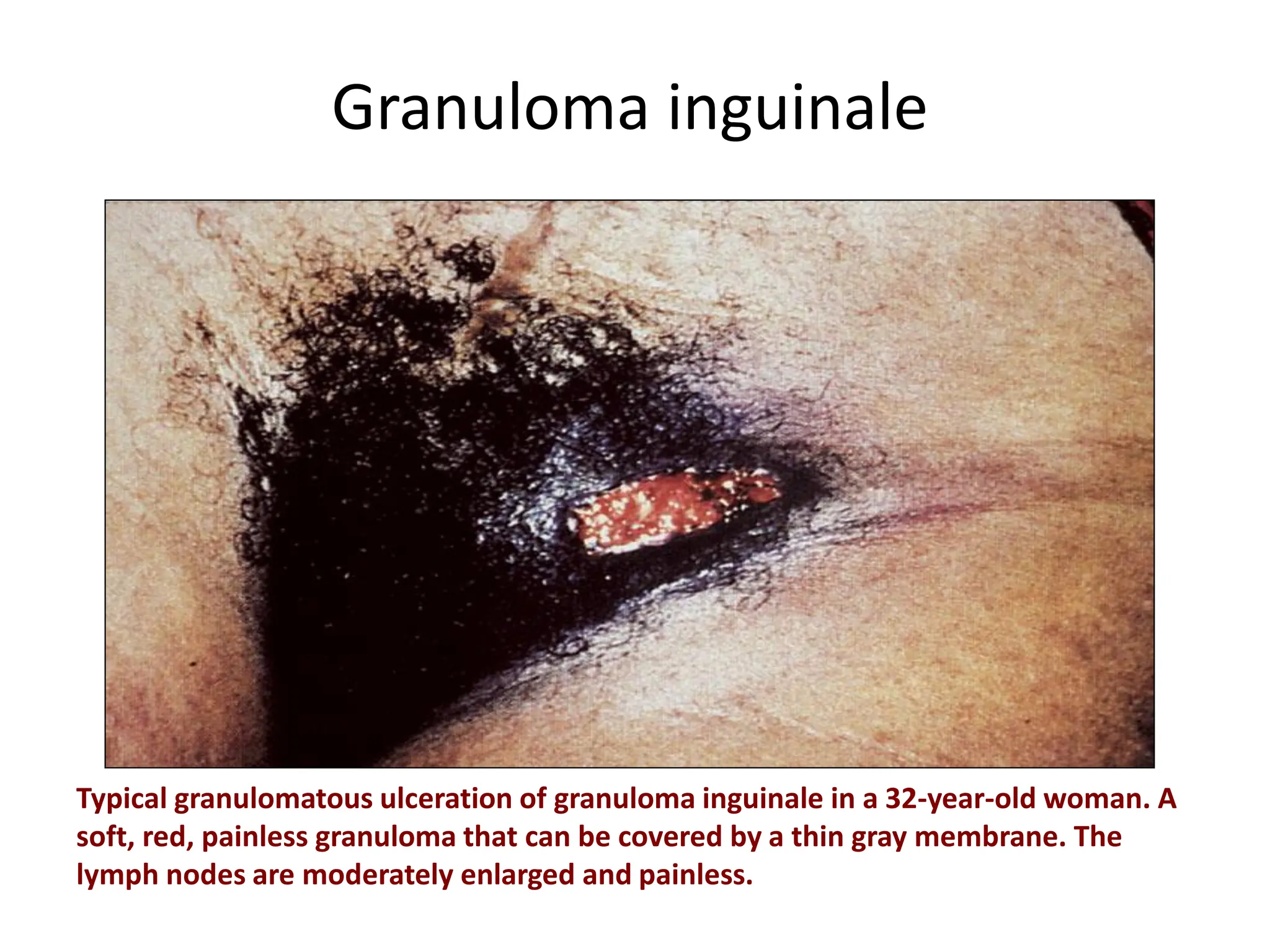 Granuloma inguinale
Typical granulomatous ulceration of granuloma inguinale in a 32-year-old woman. A
soft, red, painless granuloma that can be covered by a thin gray membrane. The
lymph nodes are moderately enlarged and painless.
 