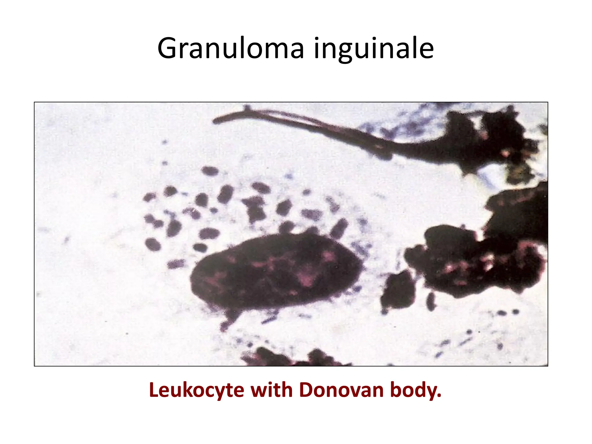 Granuloma inguinale
Leukocyte with Donovan body.
 