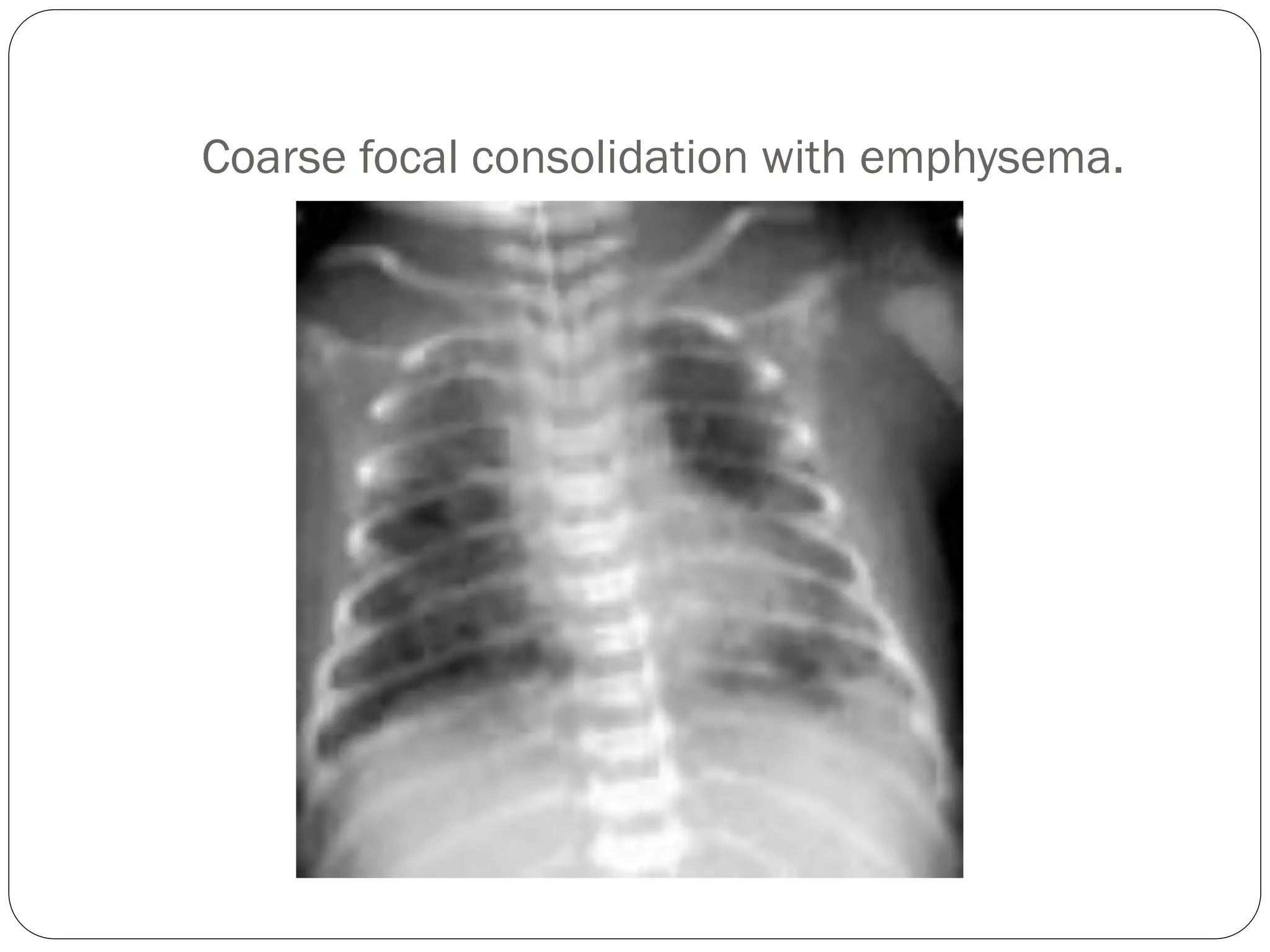 Coarse focal consolidation with emphysema.
 