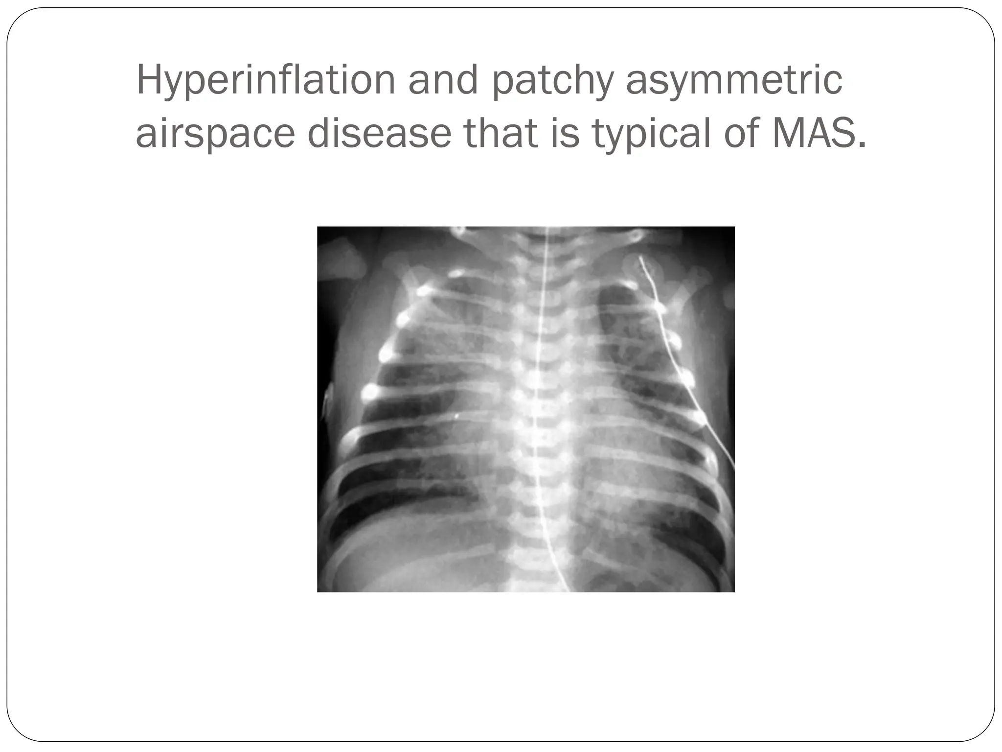 Hyperinflation and patchy asymmetric
airspace disease that is typical of MAS.
 