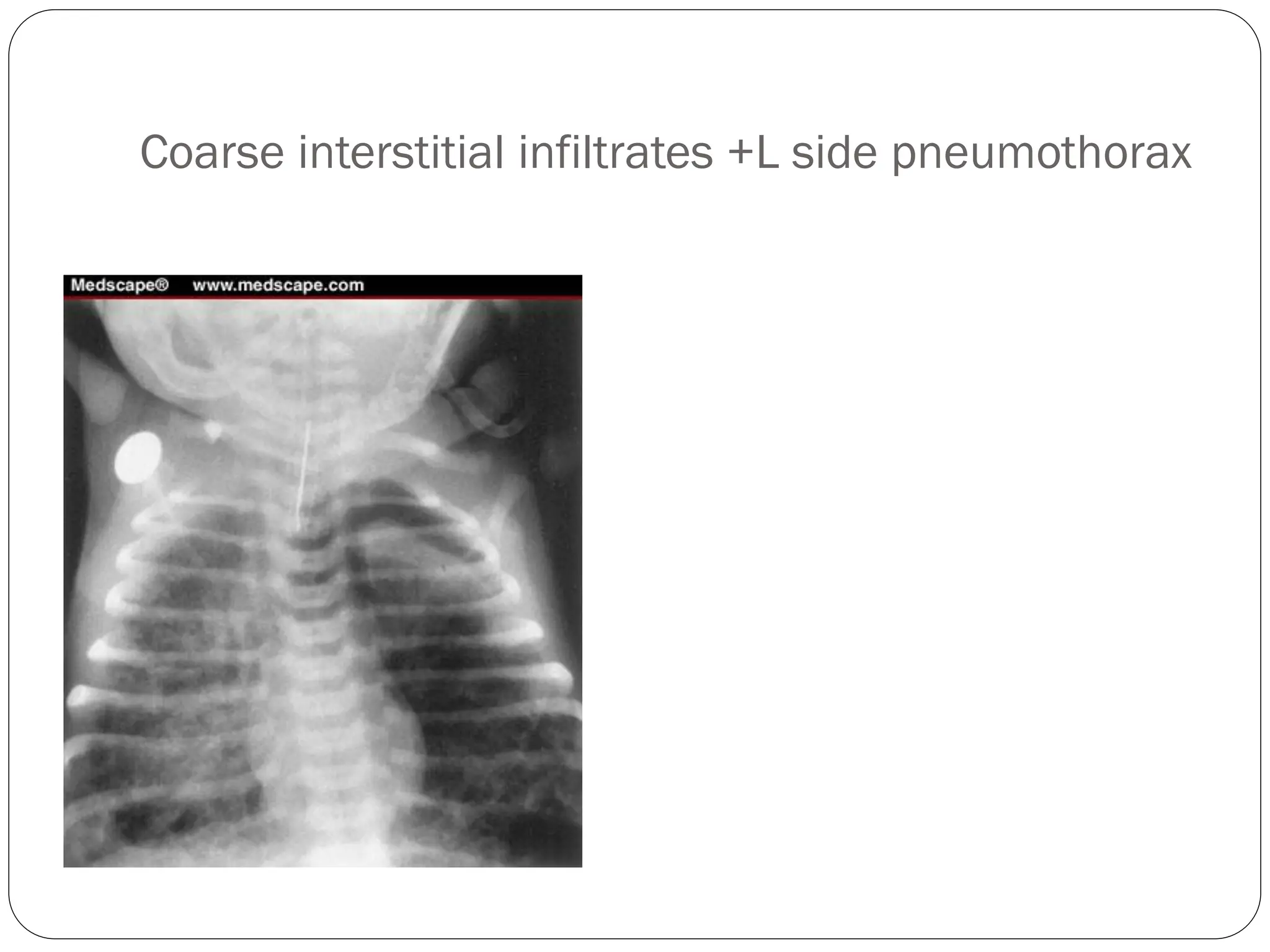 Coarse interstitial infiltrates +L side pneumothorax
 