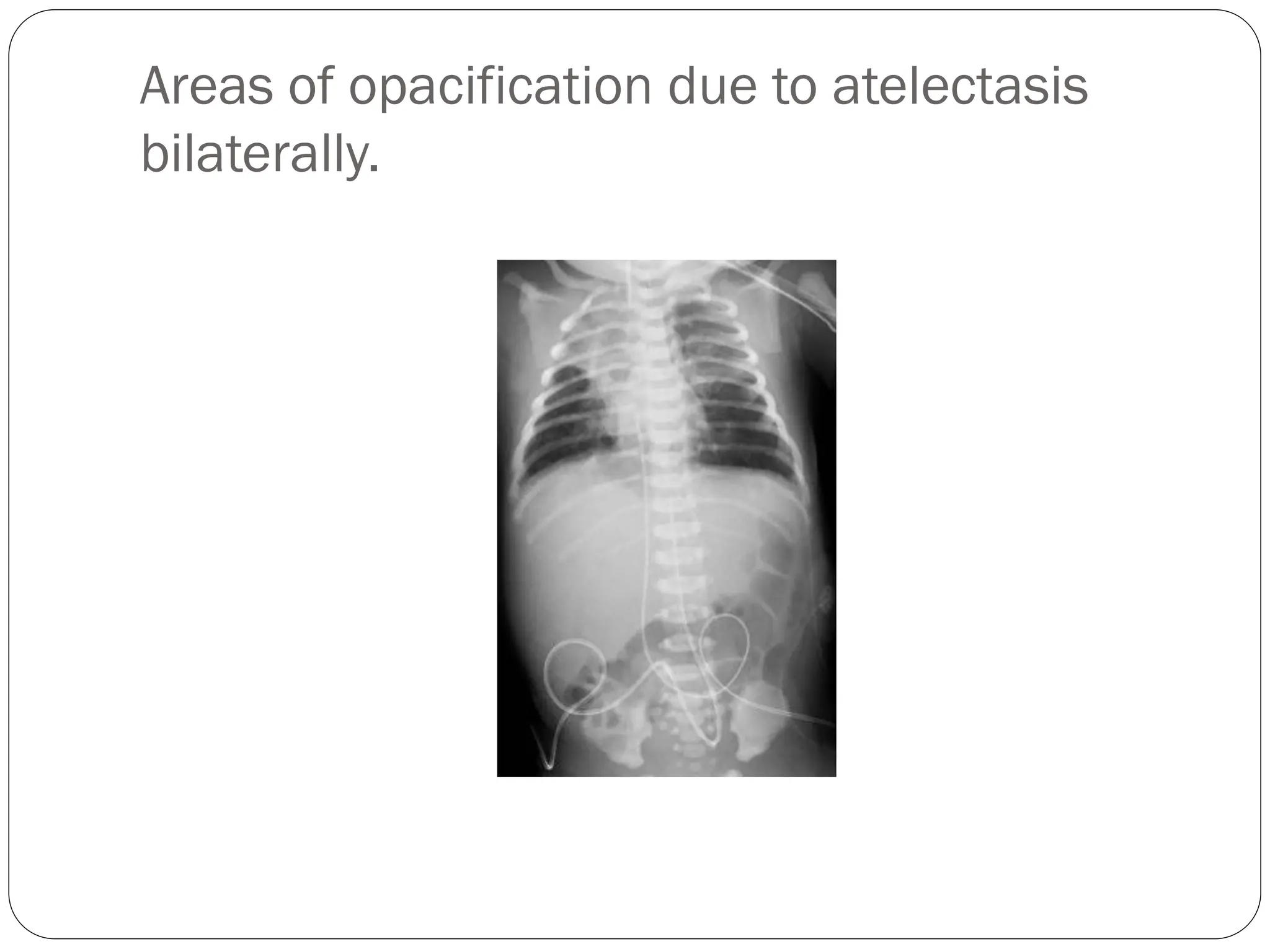 Areas of opacification due to atelectasis
bilaterally.
 
