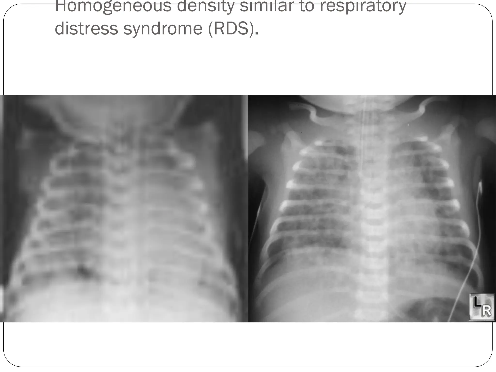 Homogeneous density similar to respiratory
distress syndrome (RDS).
 