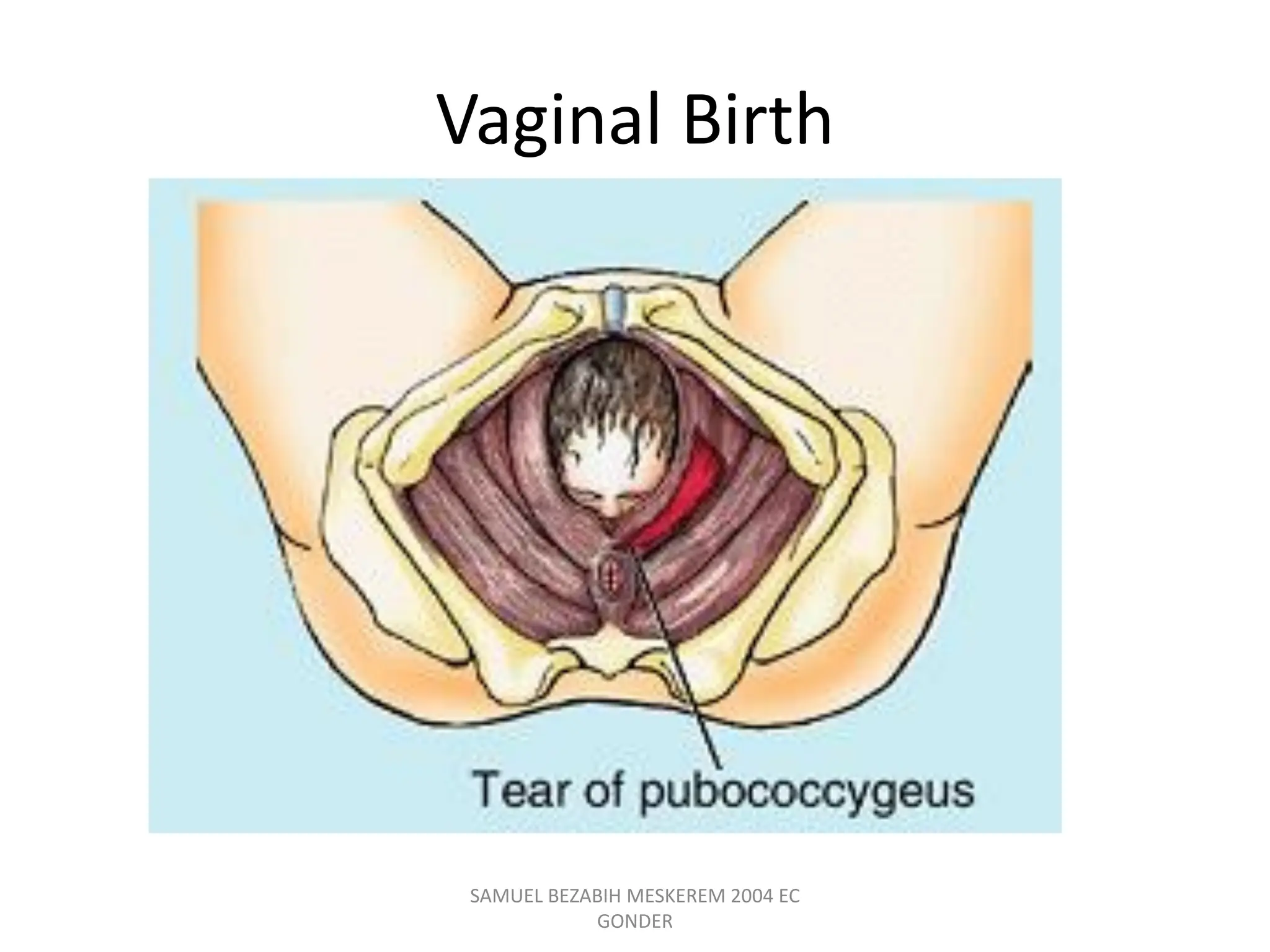 Vaginal Birth
SAMUEL BEZABIH MESKEREM 2004 EC
GONDER
 