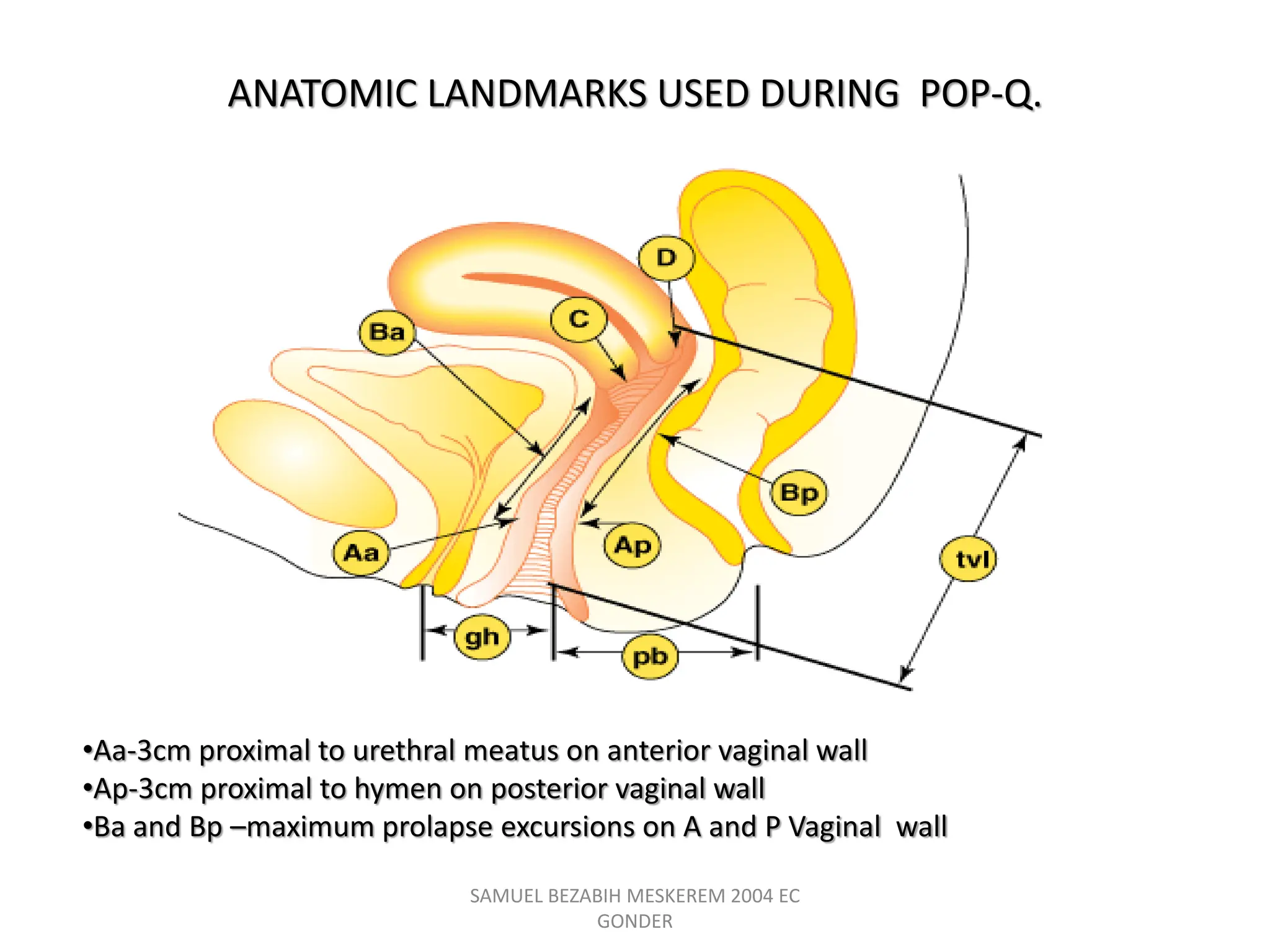 ANATOMIC LANDMARKS USED DURING POP-Q.
SAMUEL BEZABIH MESKEREM 2004 EC
GONDER
•Aa-3cm proximal to urethral meatus on anterior vaginal wall
•Ap-3cm proximal to hymen on posterior vaginal wall
•Ba and Bp –maximum prolapse excursions on A and P Vaginal wall
 