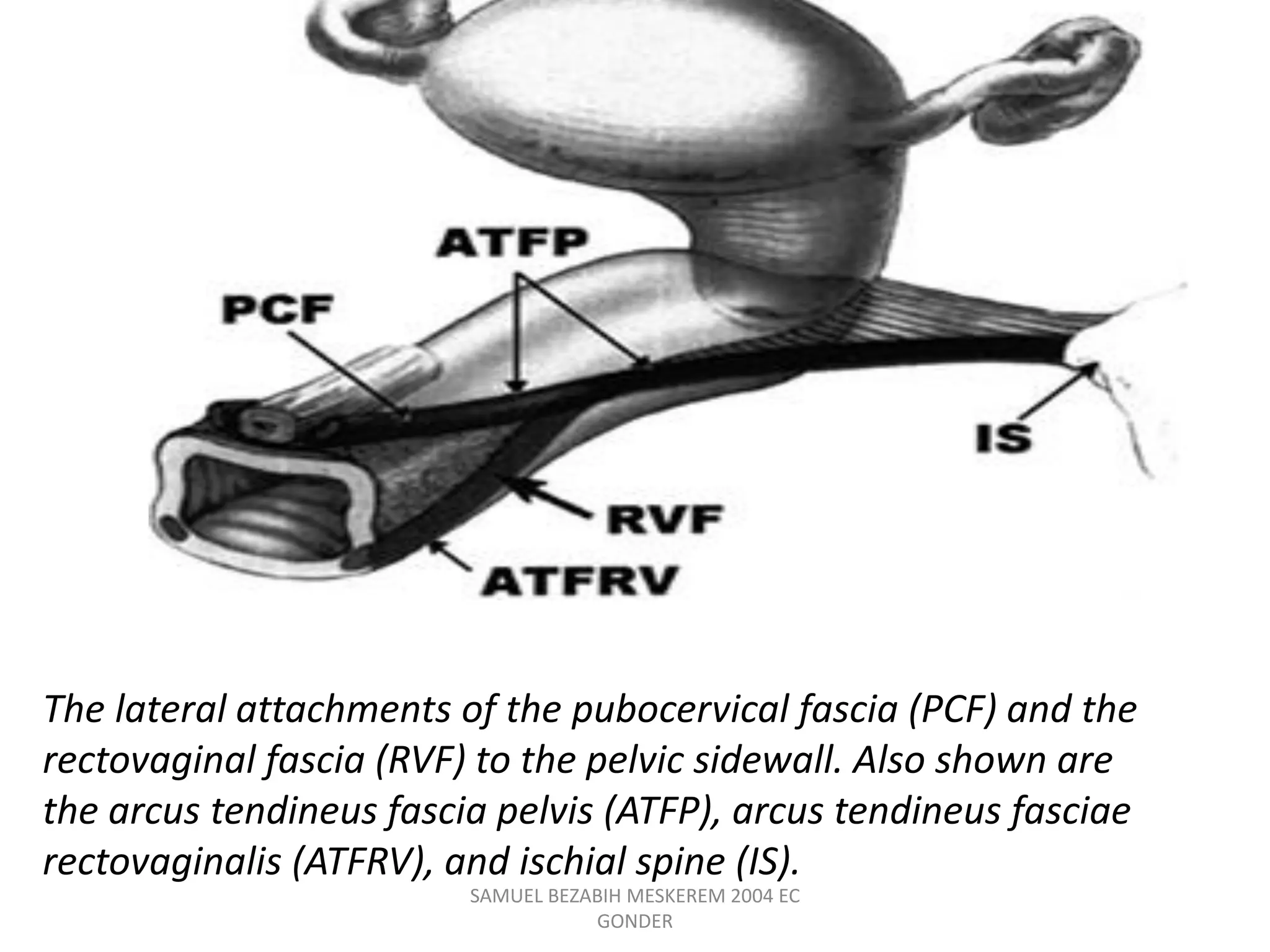 The lateral attachments of the pubocervical fascia (PCF) and the
rectovaginal fascia (RVF) to the pelvic sidewall. Also shown are
the arcus tendineus fascia pelvis (ATFP), arcus tendineus fasciae
rectovaginalis (ATFRV), and ischial spine (IS).
SAMUEL BEZABIH MESKEREM 2004 EC
GONDER
 