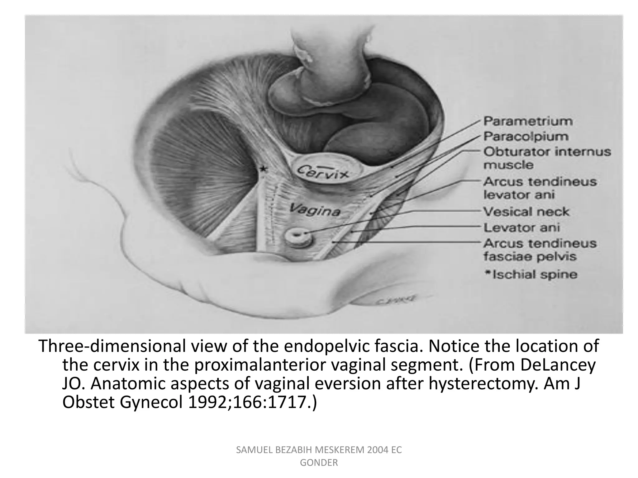 Three-dimensional view of the endopelvic fascia. Notice the location of
the cervix in the proximalanterior vaginal segment. (From DeLancey
JO. Anatomic aspects of vaginal eversion after hysterectomy. Am J
Obstet Gynecol 1992;166:1717.)
SAMUEL BEZABIH MESKEREM 2004 EC
GONDER
 