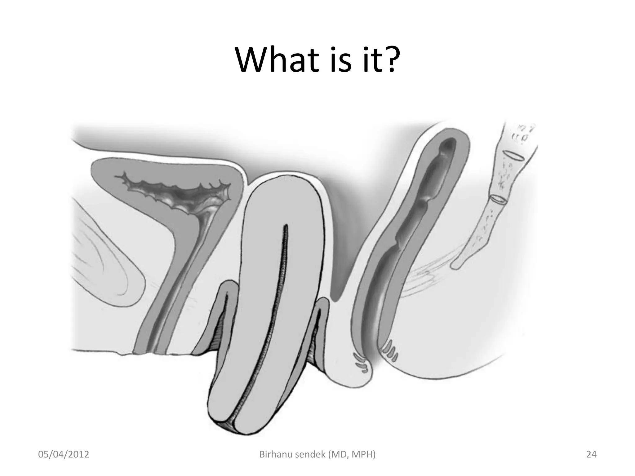 What is it?
05/04/2012 24
Birhanu sendek (MD, MPH)
 