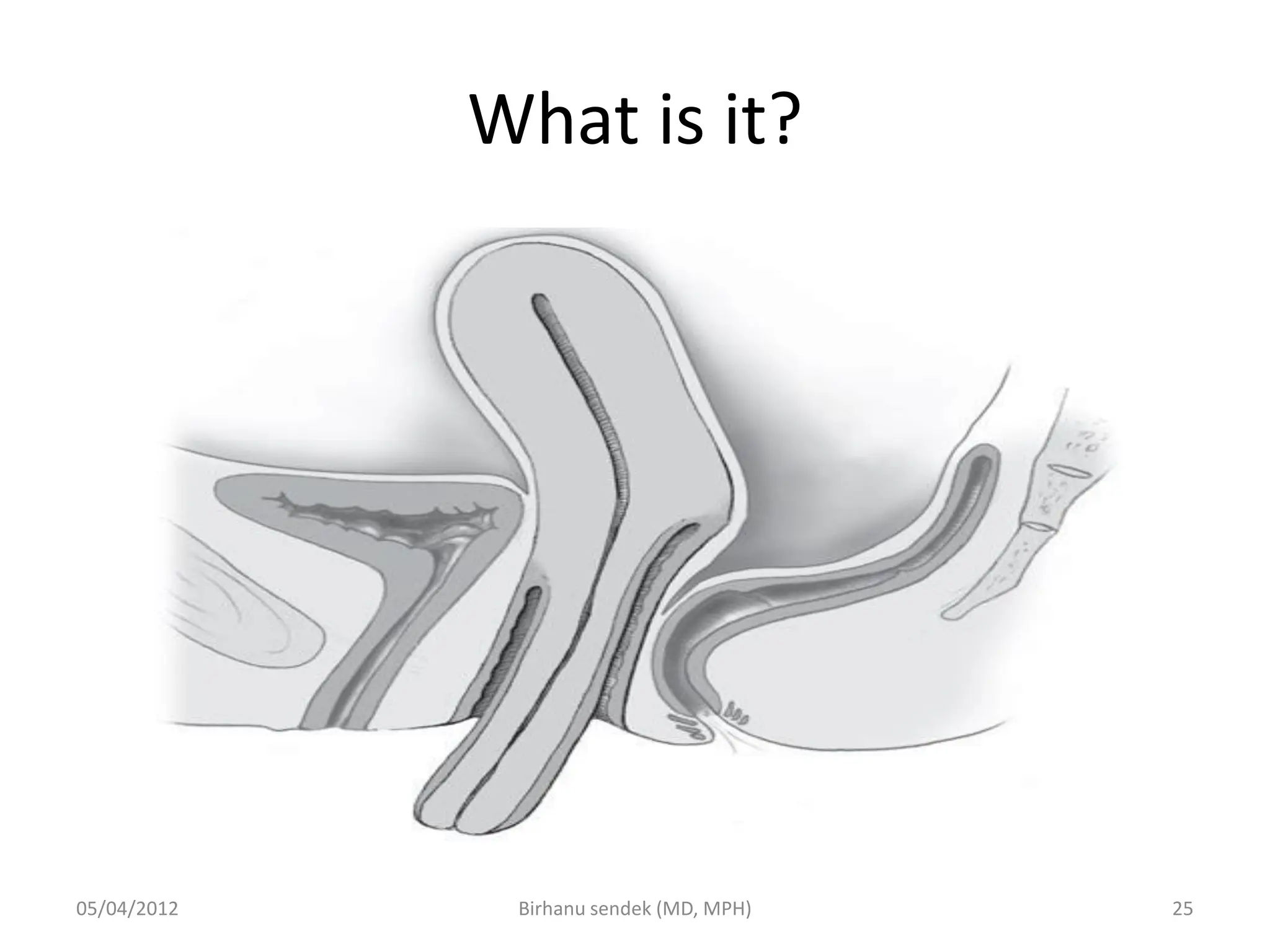 What is it?
05/04/2012 25
Birhanu sendek (MD, MPH)
 