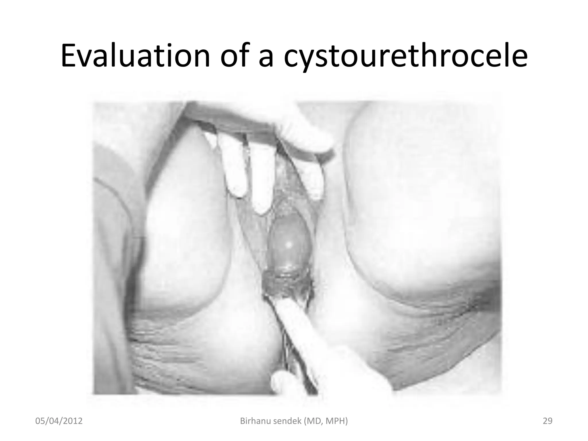 Evaluation of a cystourethrocele
05/04/2012 29
Birhanu sendek (MD, MPH)
 