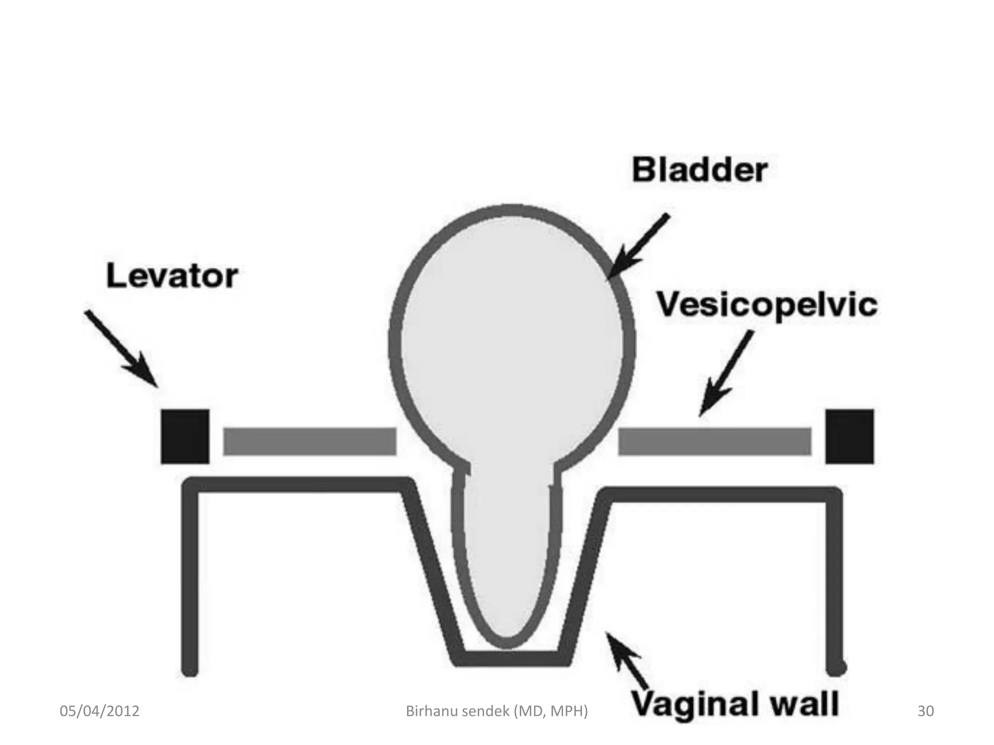 05/04/2012 30
Birhanu sendek (MD, MPH)
 