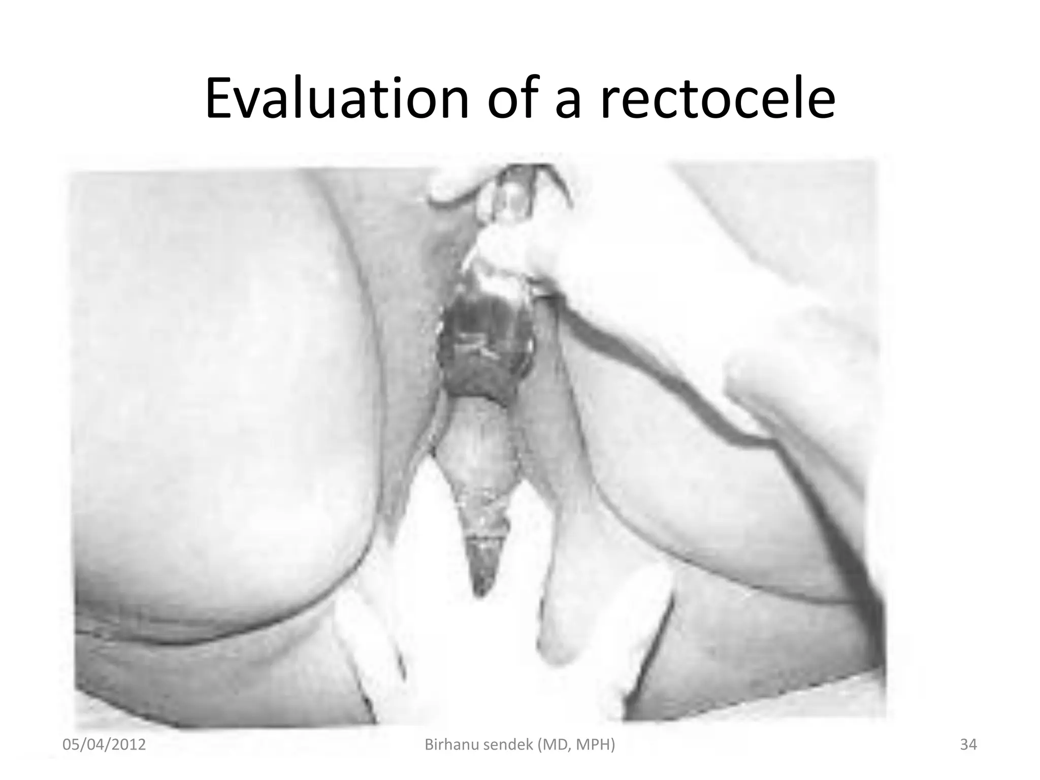 Evaluation of a rectocele
05/04/2012 34
Birhanu sendek (MD, MPH)
 