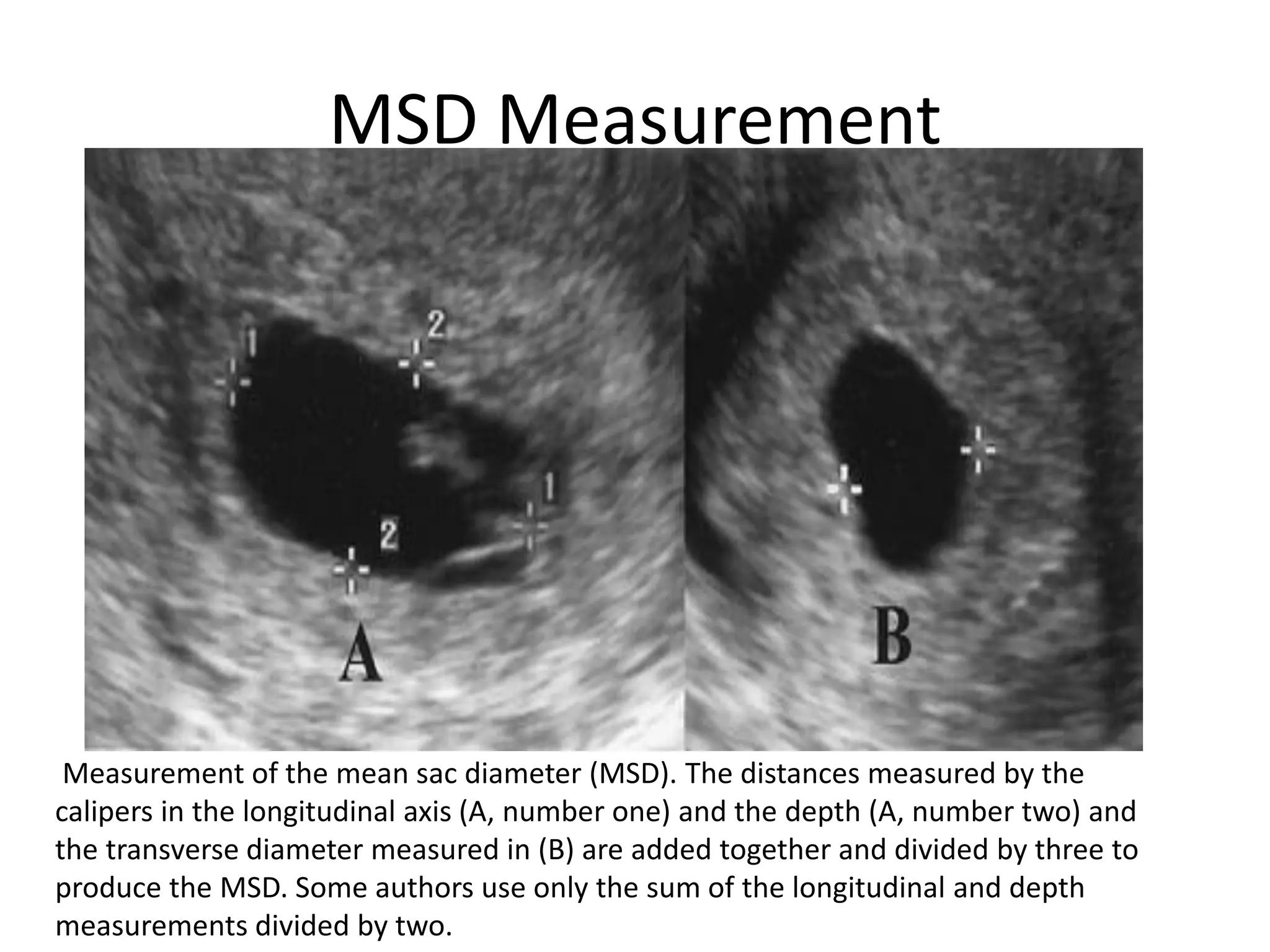 MSD Measurement
Measurement of the mean sac diameter (MSD). The distances measured by the
calipers in the longitudinal axis (A, number one) and the depth (A, number two) and
the transverse diameter measured in (B) are added together and divided by three to
produce the MSD. Some authors use only the sum of the longitudinal and depth
measurements divided by two.
 