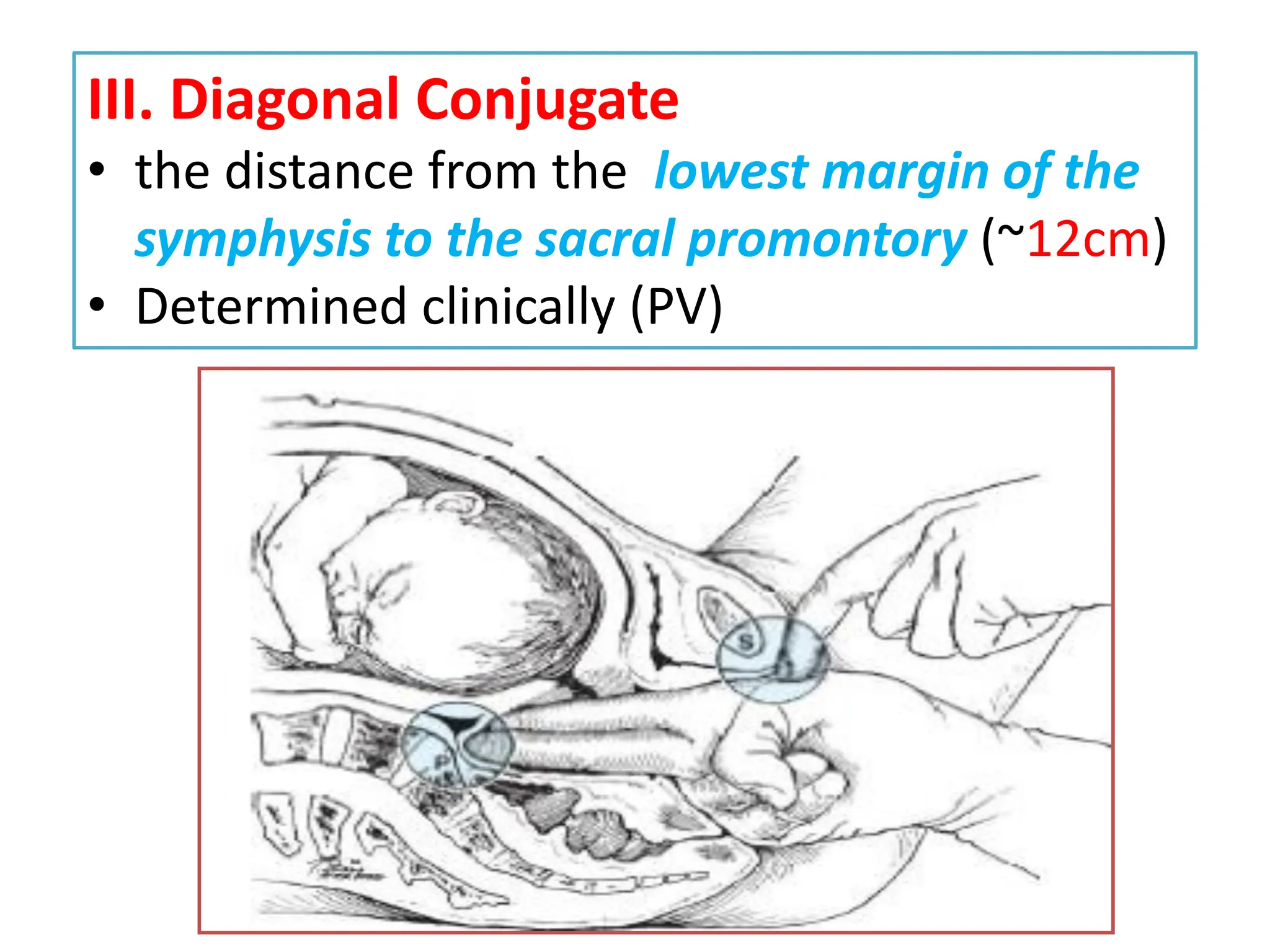 III. Diagonal Conjugate
• the distance from the lowest margin of the
symphysis to the sacral promontory (~12cm)
• Determined clinically (PV)
 