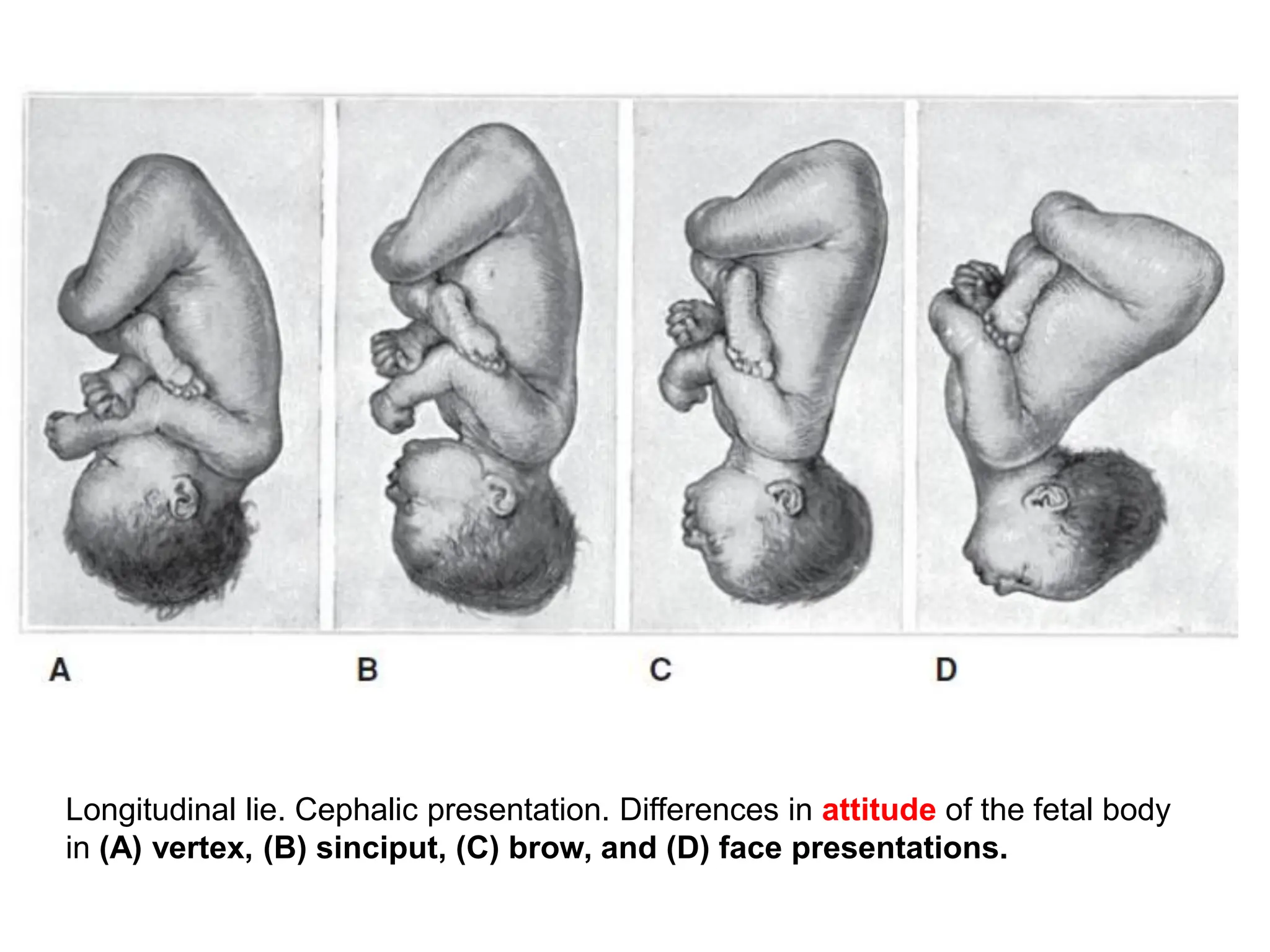 Longitudinal lie. Cephalic presentation. Differences in attitude of the fetal body
in (A) vertex, (B) sinciput, (C) brow, and (D) face presentations.
 