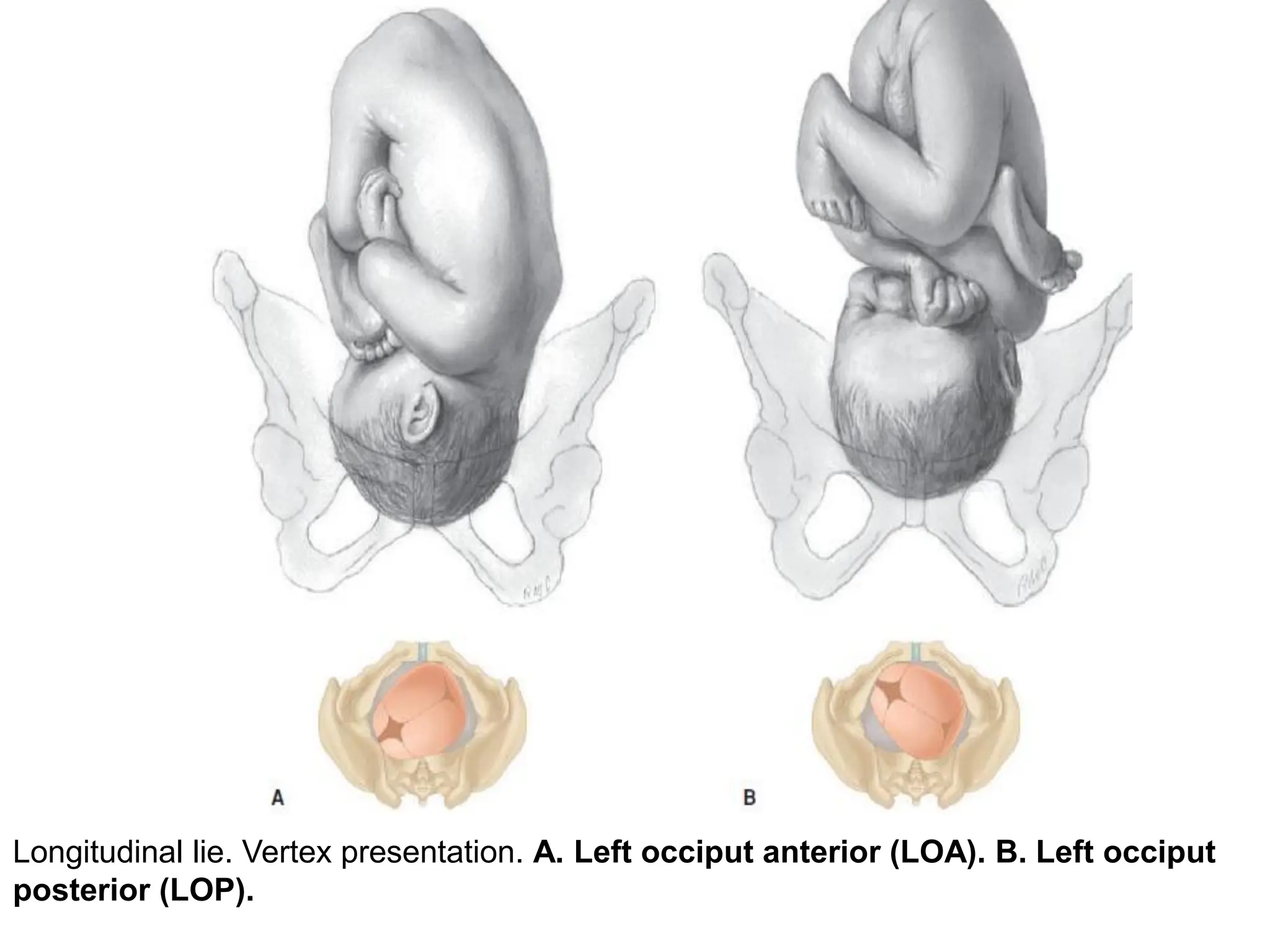 Longitudinal lie. Vertex presentation. A. Left occiput anterior (LOA). B. Left occiput
posterior (LOP).
 