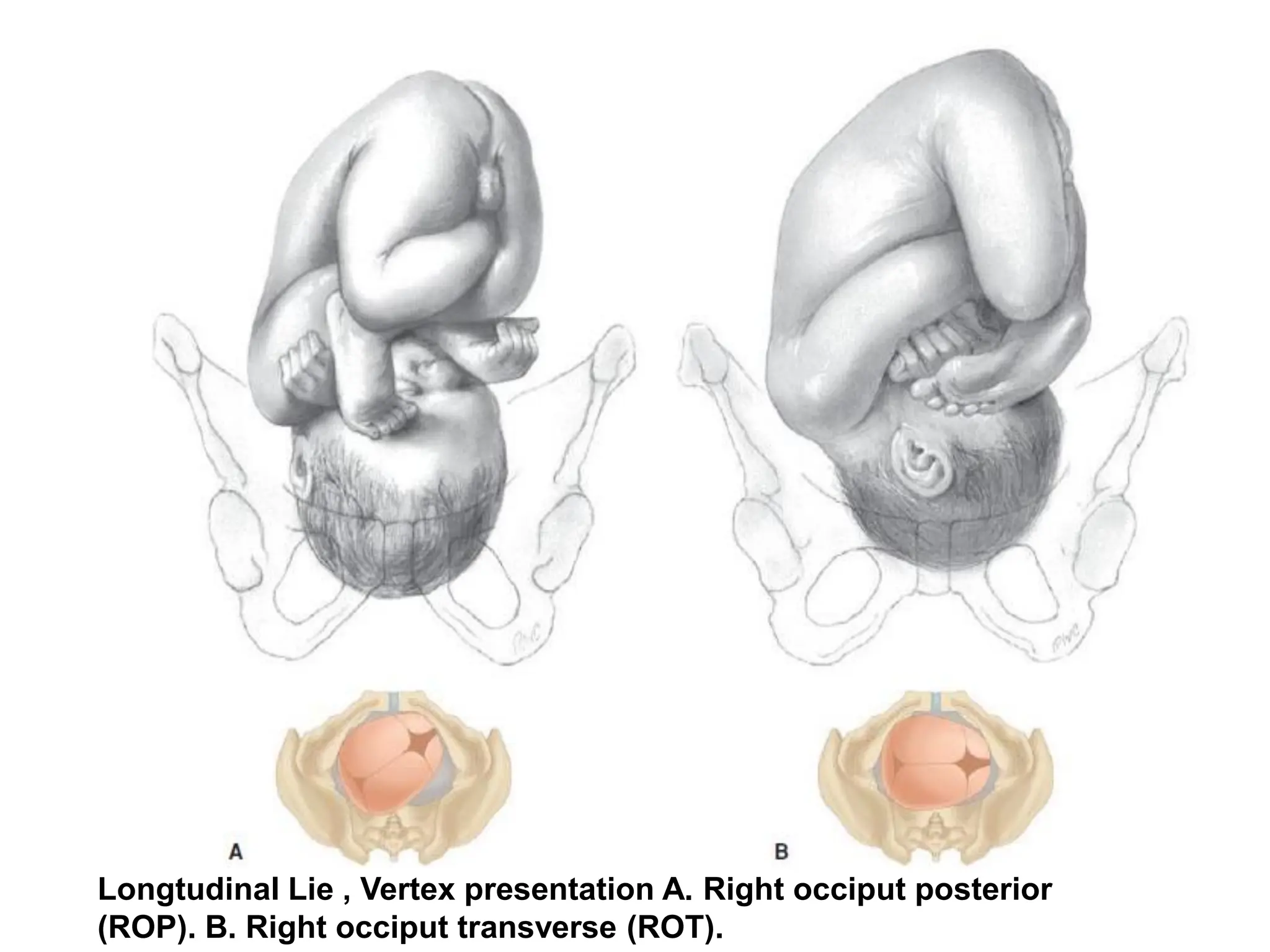 Longtudinal Lie , Vertex presentation A. Right occiput posterior
(ROP). B. Right occiput transverse (ROT).
 