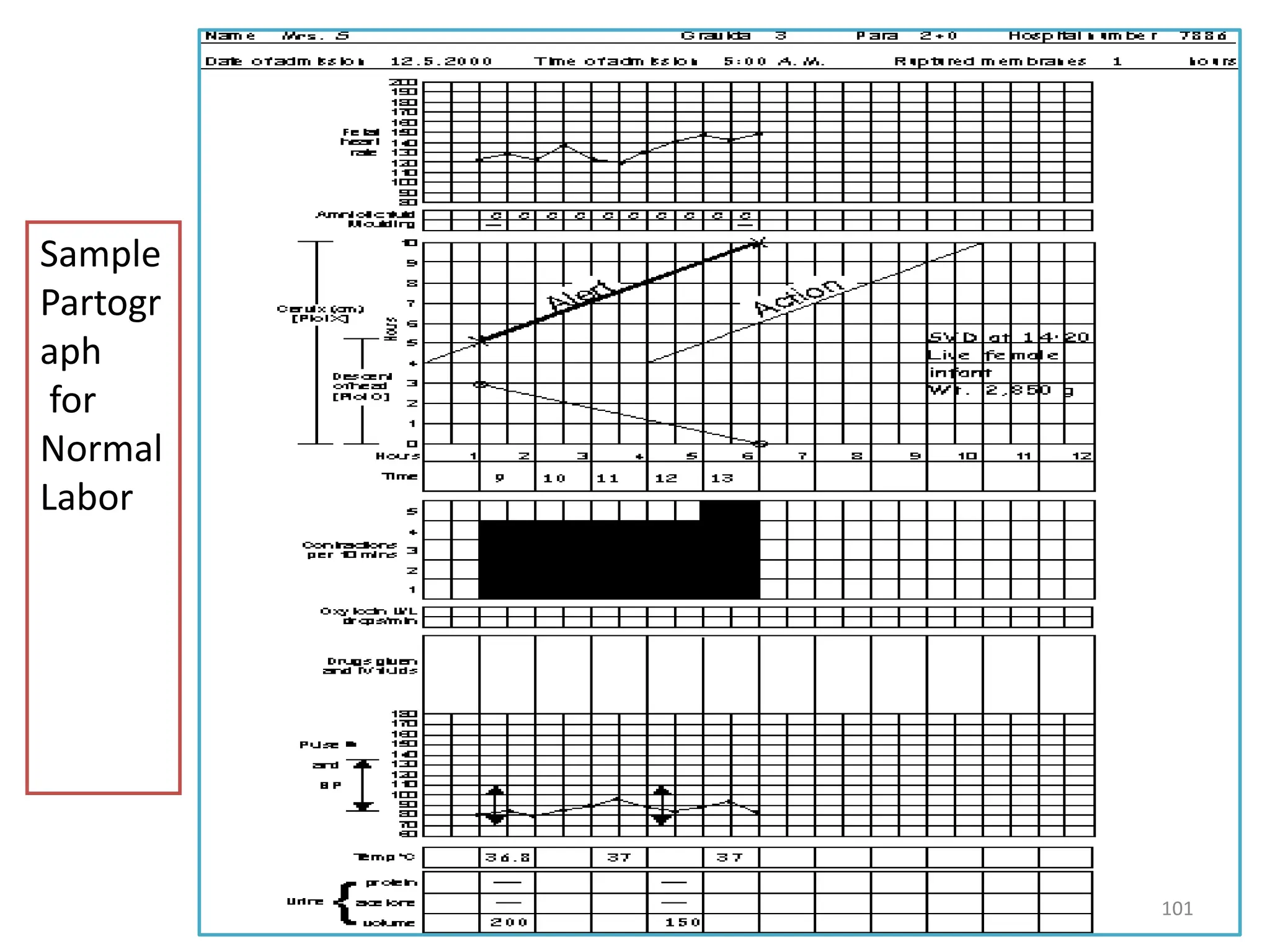 Sample
Partogr
aph
for
Normal
Labor
101
 