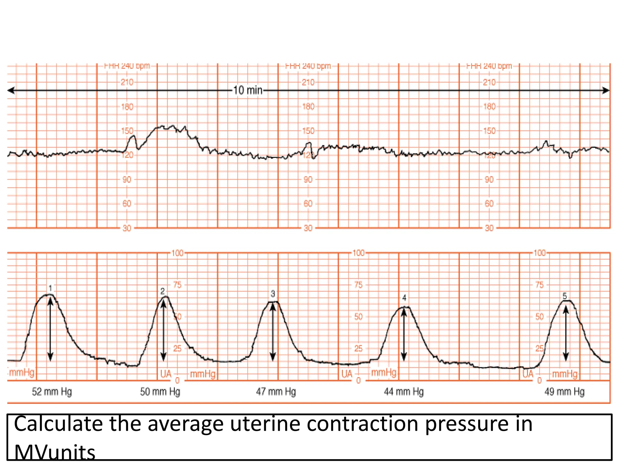 Calculate the average uterine contraction pressure in
MVunits
 