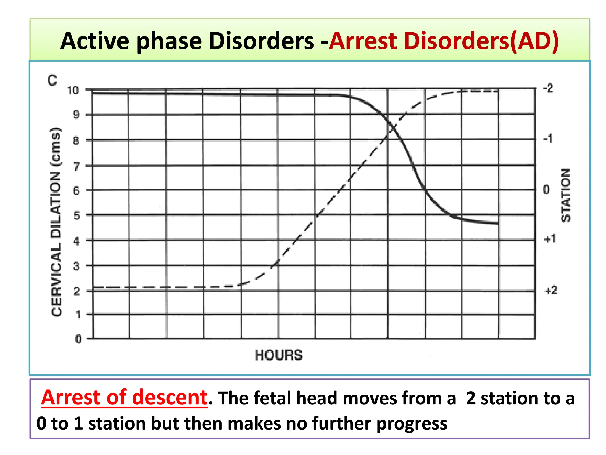 Active phase Disorders -Arrest Disorders(AD)
Arrest of descent. The fetal head moves from a 2 station to a
0 to 1 station but then makes no further progress
 
