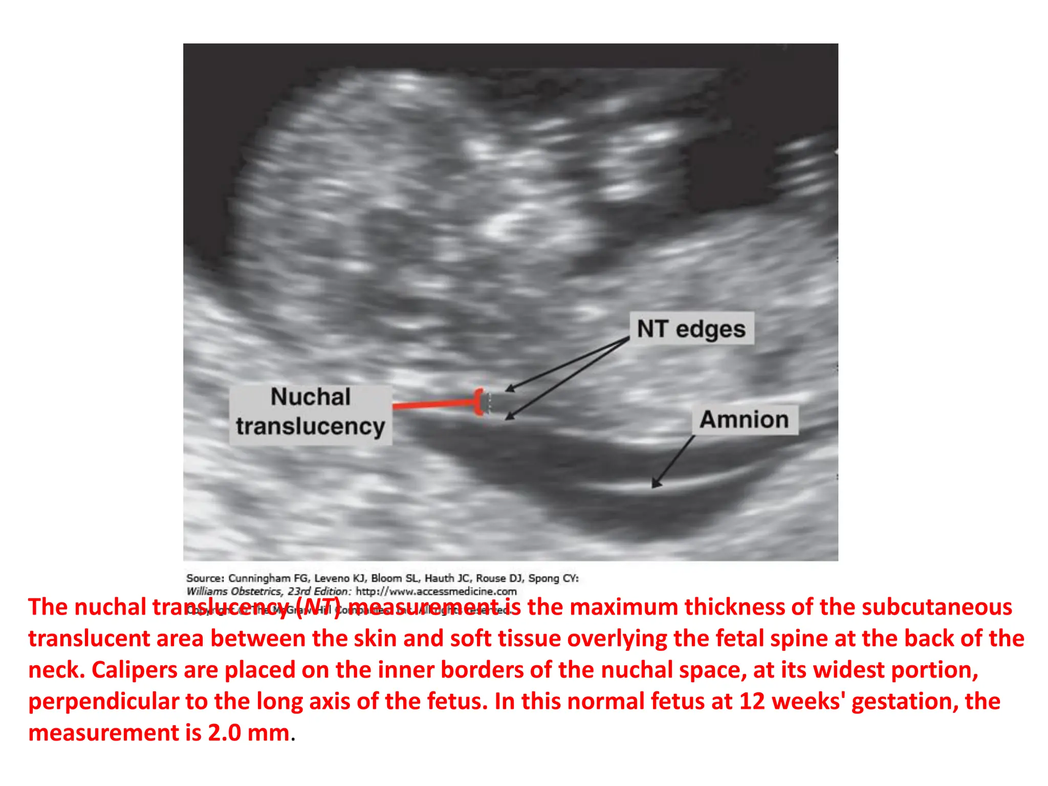 The nuchal translucency (NT) measurement is the maximum thickness of the subcutaneous
translucent area between the skin and soft tissue overlying the fetal spine at the back of the
neck. Calipers are placed on the inner borders of the nuchal space, at its widest portion,
perpendicular to the long axis of the fetus. In this normal fetus at 12 weeks' gestation, the
measurement is 2.0 mm.
 