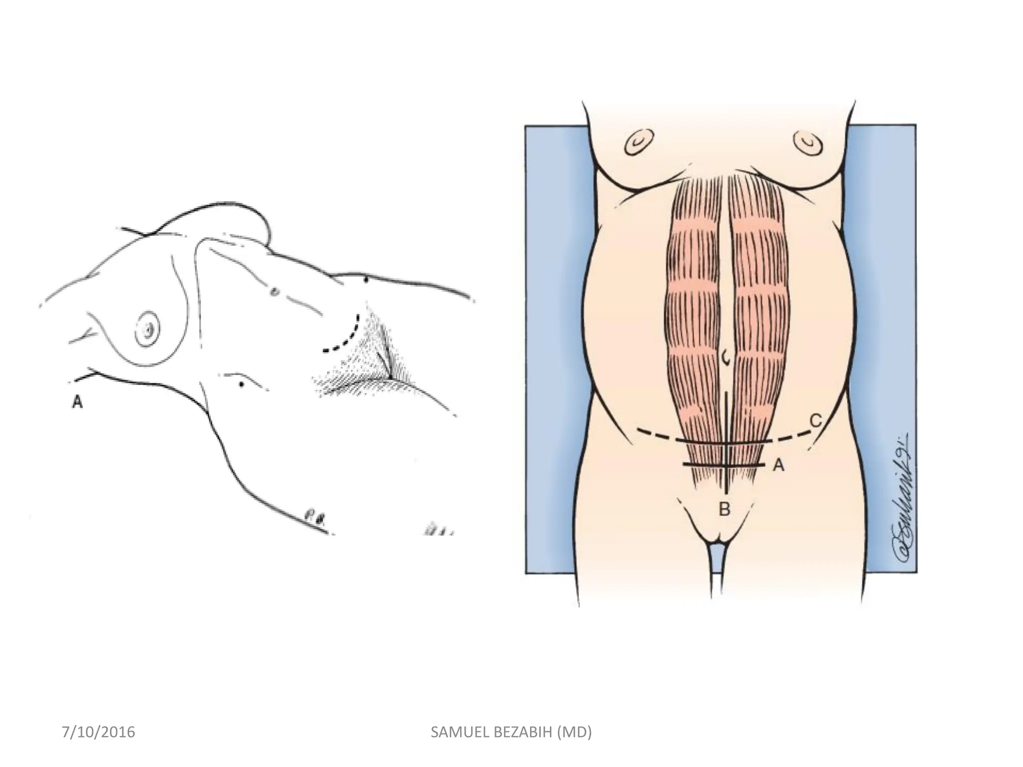 7/10/2016 SAMUEL BEZABIH (MD)
 
