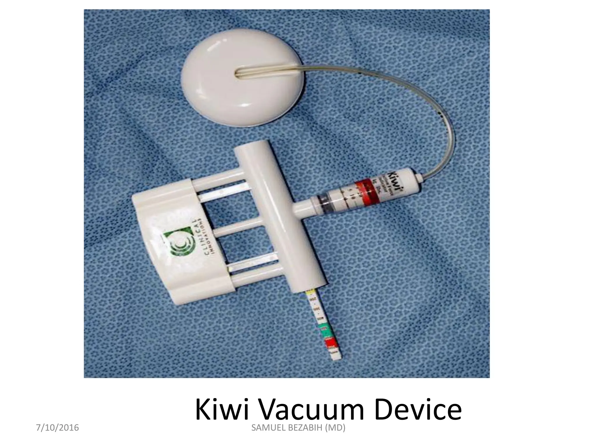 Kiwi Vacuum Device
7/10/2016 SAMUEL BEZABIH (MD)
 