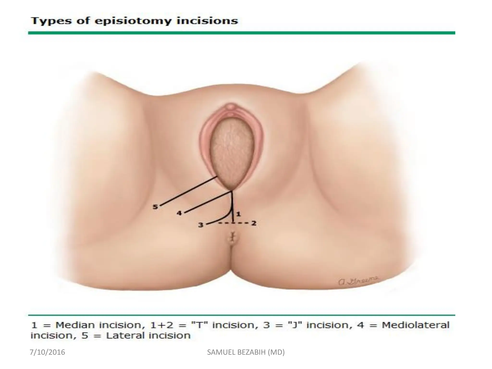 7/10/2016 SAMUEL BEZABIH (MD)
 