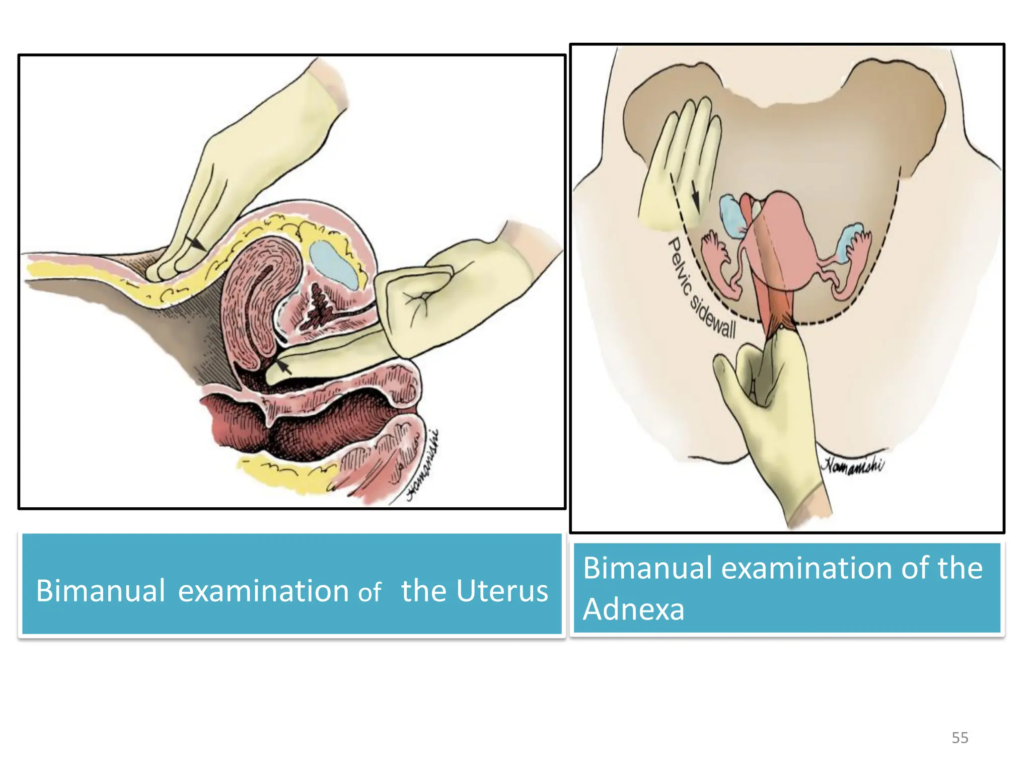 Bimanual examination of the Uterus
Bimanual examination of the
Adnexa
55
 