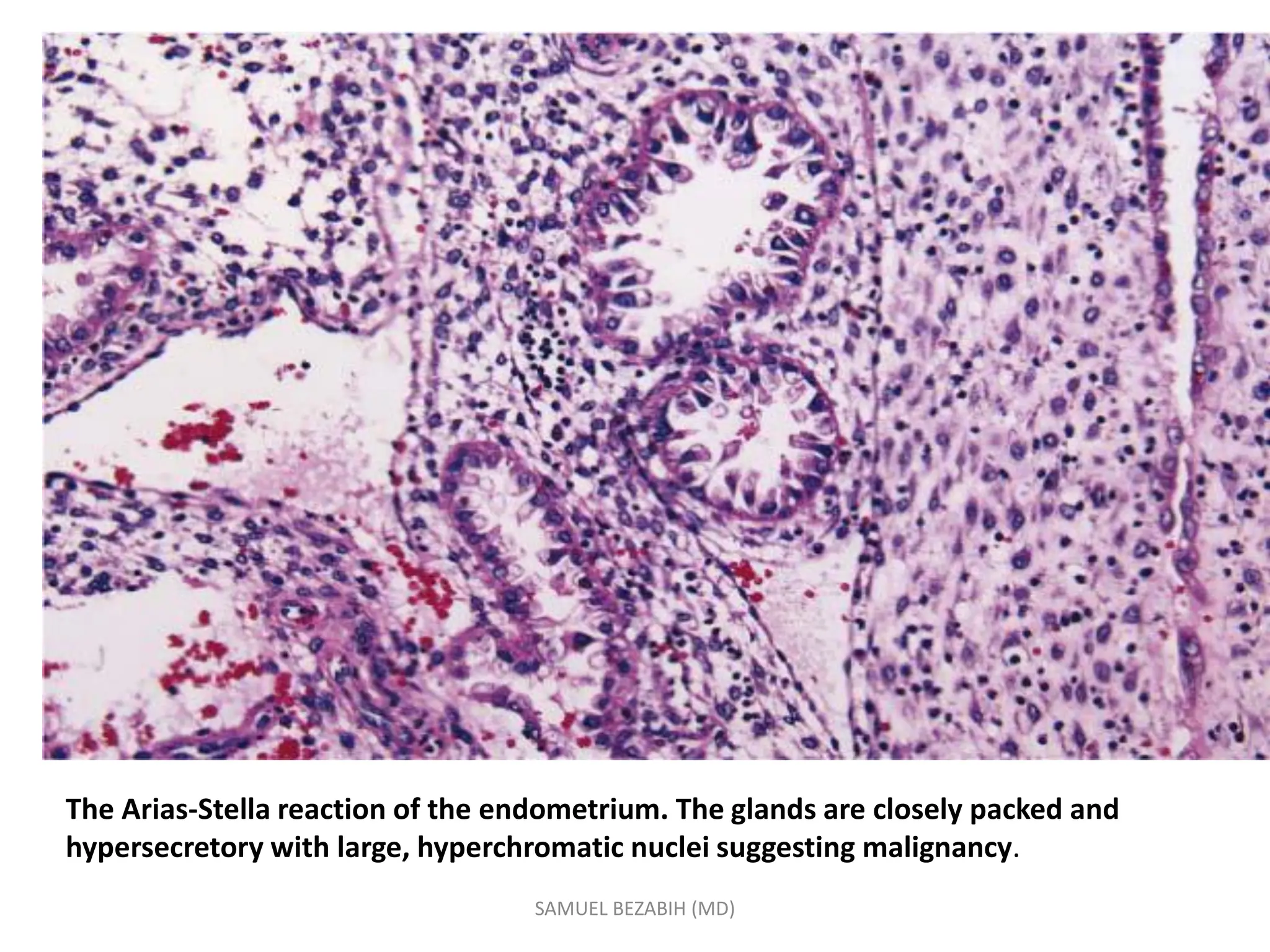 The Arias-Stella reaction of the endometrium. The glands are closely packed and
hypersecretory with large, hyperchromatic nuclei suggesting malignancy.
SAMUEL BEZABIH (MD)
 