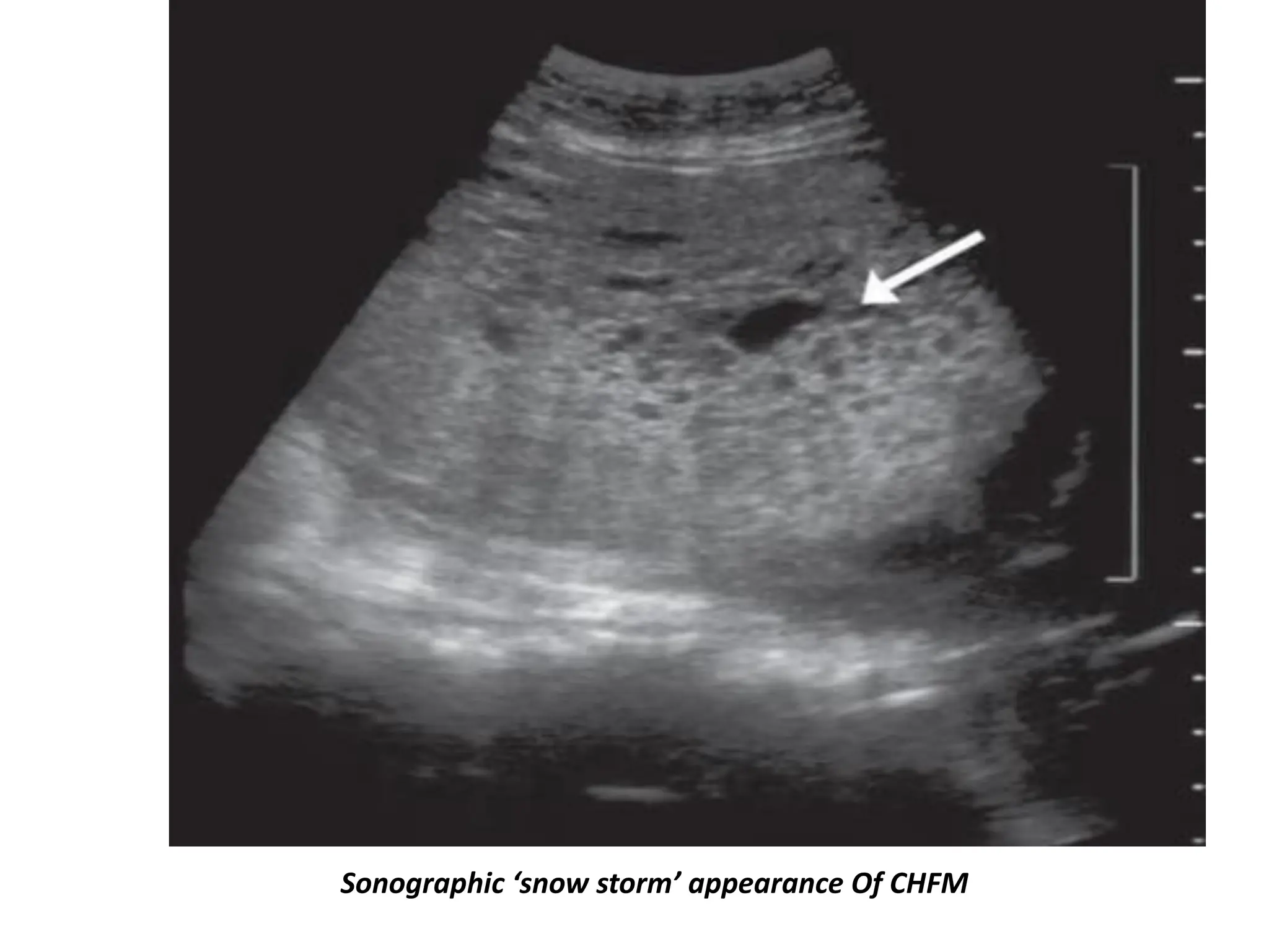 Sonographic ‘snow storm’ appearance Of CHFM
 