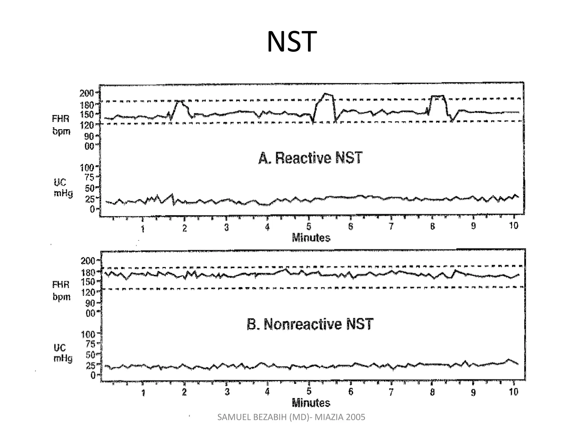 NST
SAMUEL BEZABIH (MD)- MIAZIA 2005
 