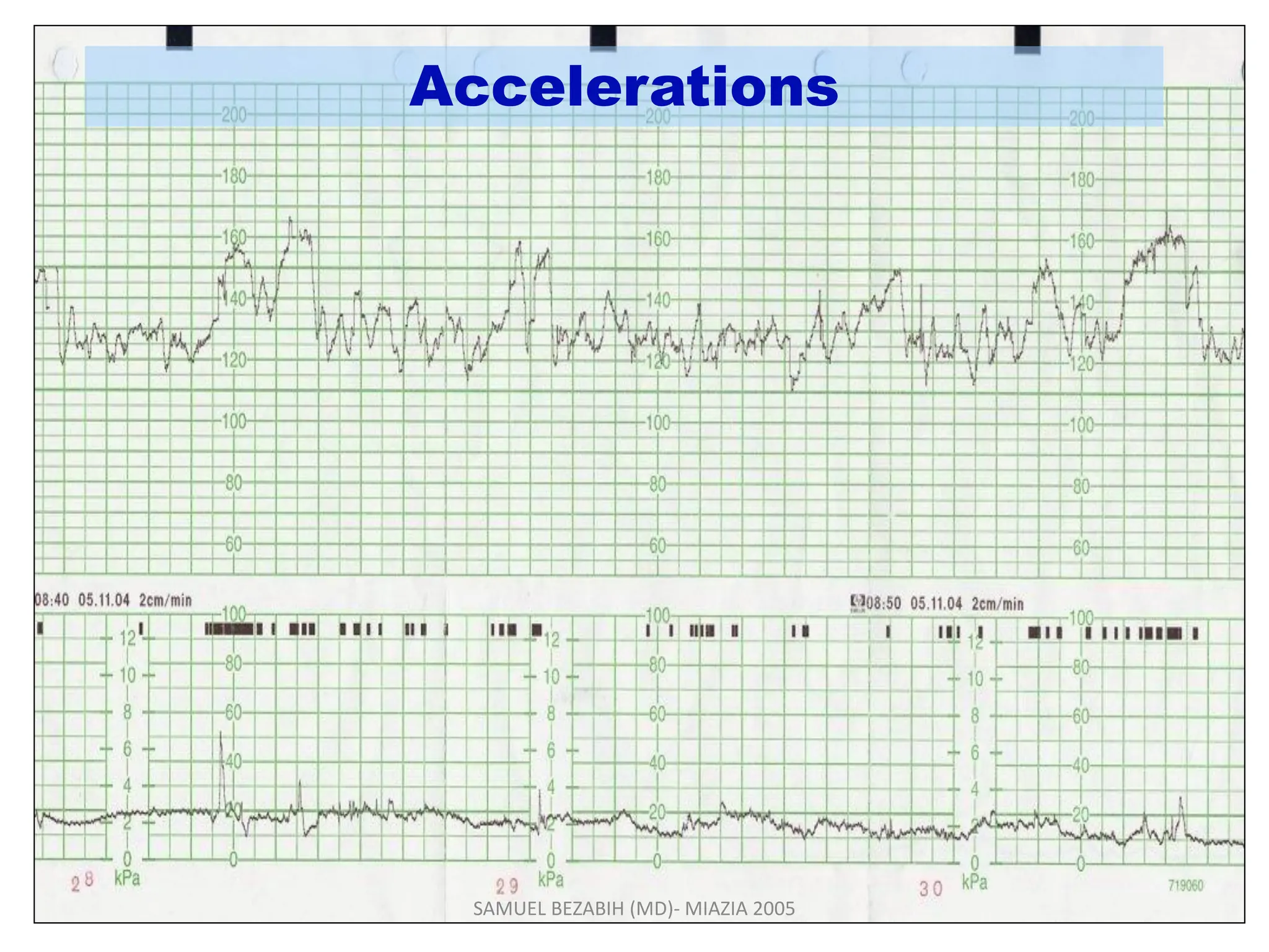Accelerations
SAMUEL BEZABIH (MD)- MIAZIA 2005
 