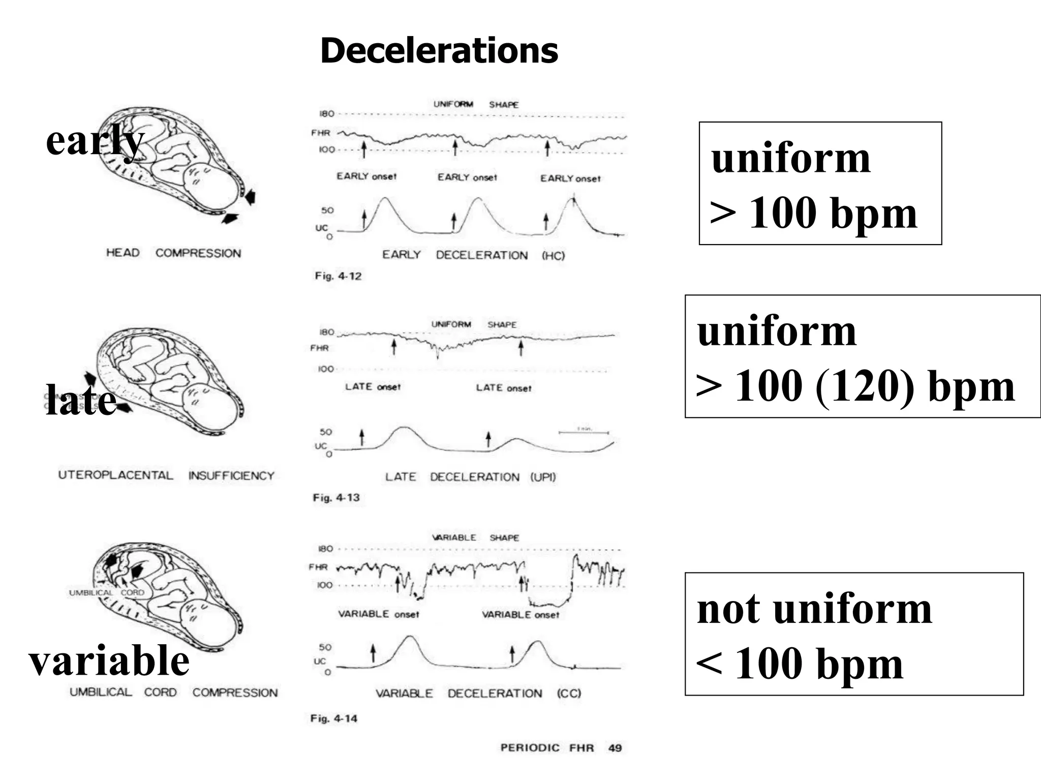uniform
> 100 bpm
uniform
> 100 (120) bpm
not uniform
< 100 bpm
early
late
variable
Decelerations
 