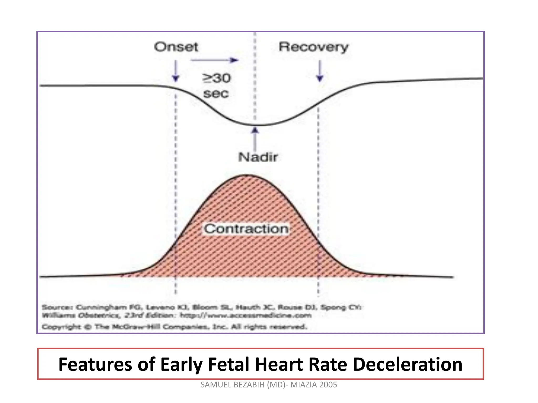Features of Early Fetal Heart Rate Deceleration
SAMUEL BEZABIH (MD)- MIAZIA 2005
 