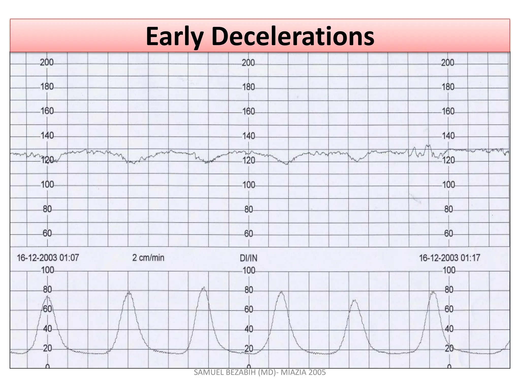 Early Decelerations
SAMUEL BEZABIH (MD)- MIAZIA 2005
 