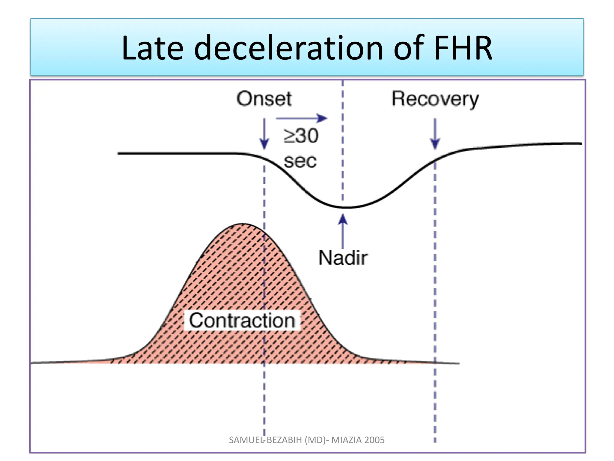 Late deceleration of FHR
SAMUEL BEZABIH (MD)- MIAZIA 2005
 