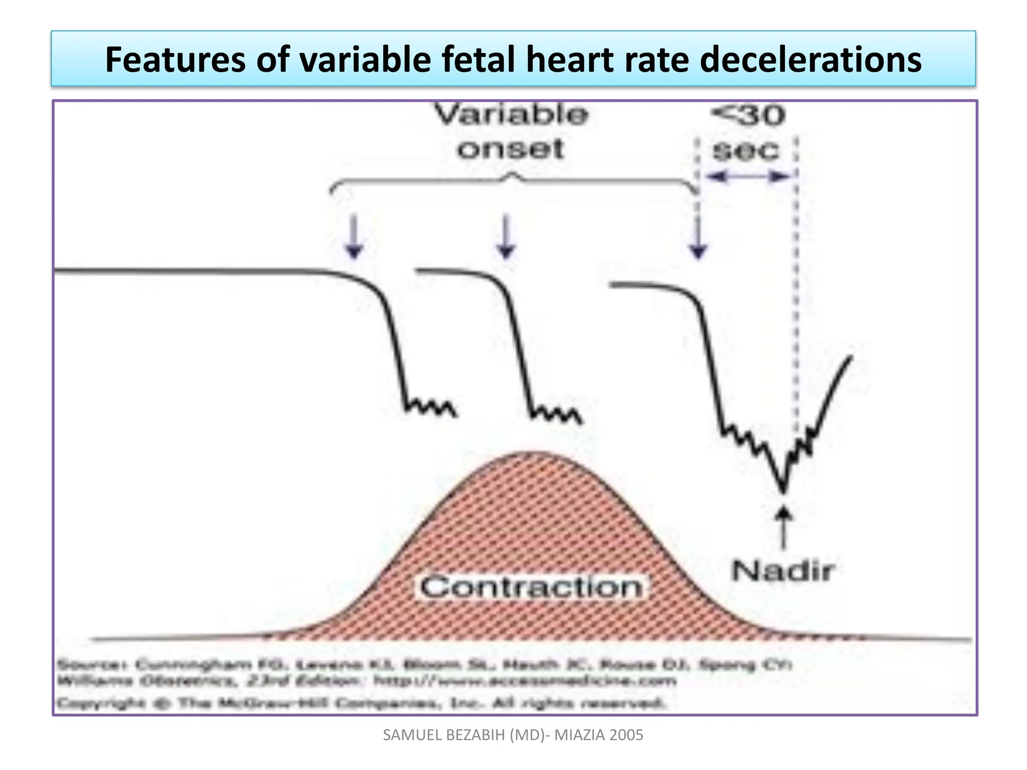Features of variable fetal heart rate decelerations
SAMUEL BEZABIH (MD)- MIAZIA 2005
 