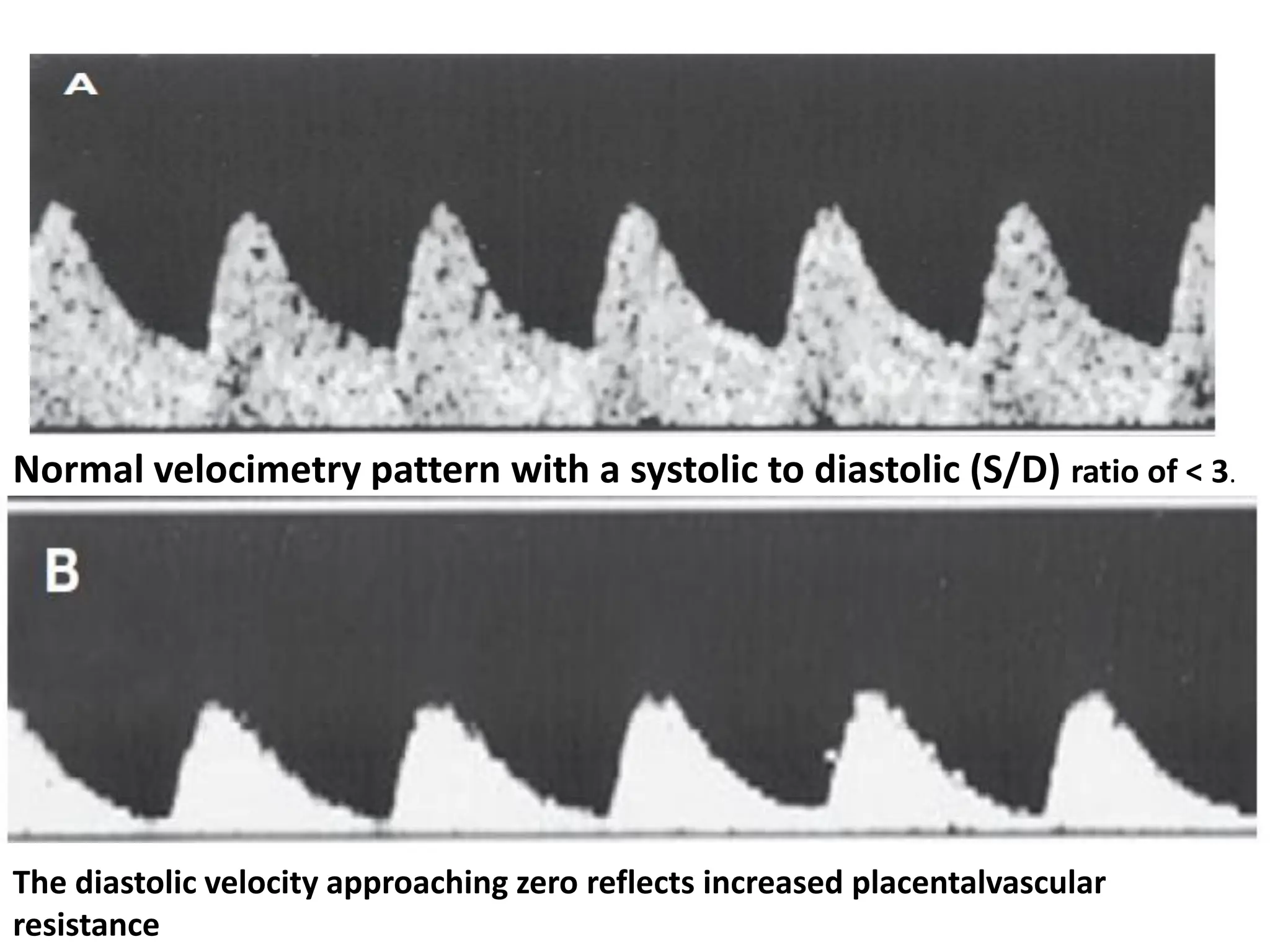 Normal velocimetry pattern with a systolic to diastolic (S/D) ratio of < 3.
The diastolic velocity approaching zero reflects increased placentalvascular
resistance
 