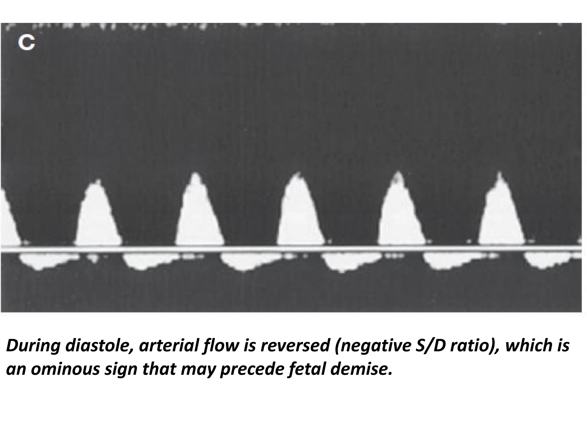 During diastole, arterial flow is reversed (negative S/D ratio), which is
an ominous sign that may precede fetal demise.
 