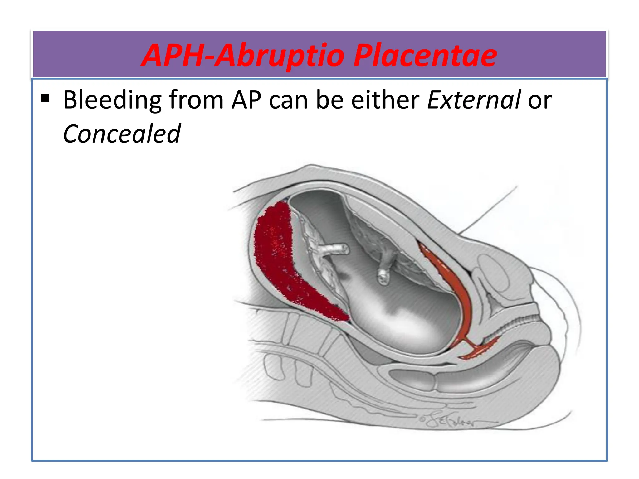APH-Abruptio Placentae
 Bleeding from AP can be either External or
Concealed
 