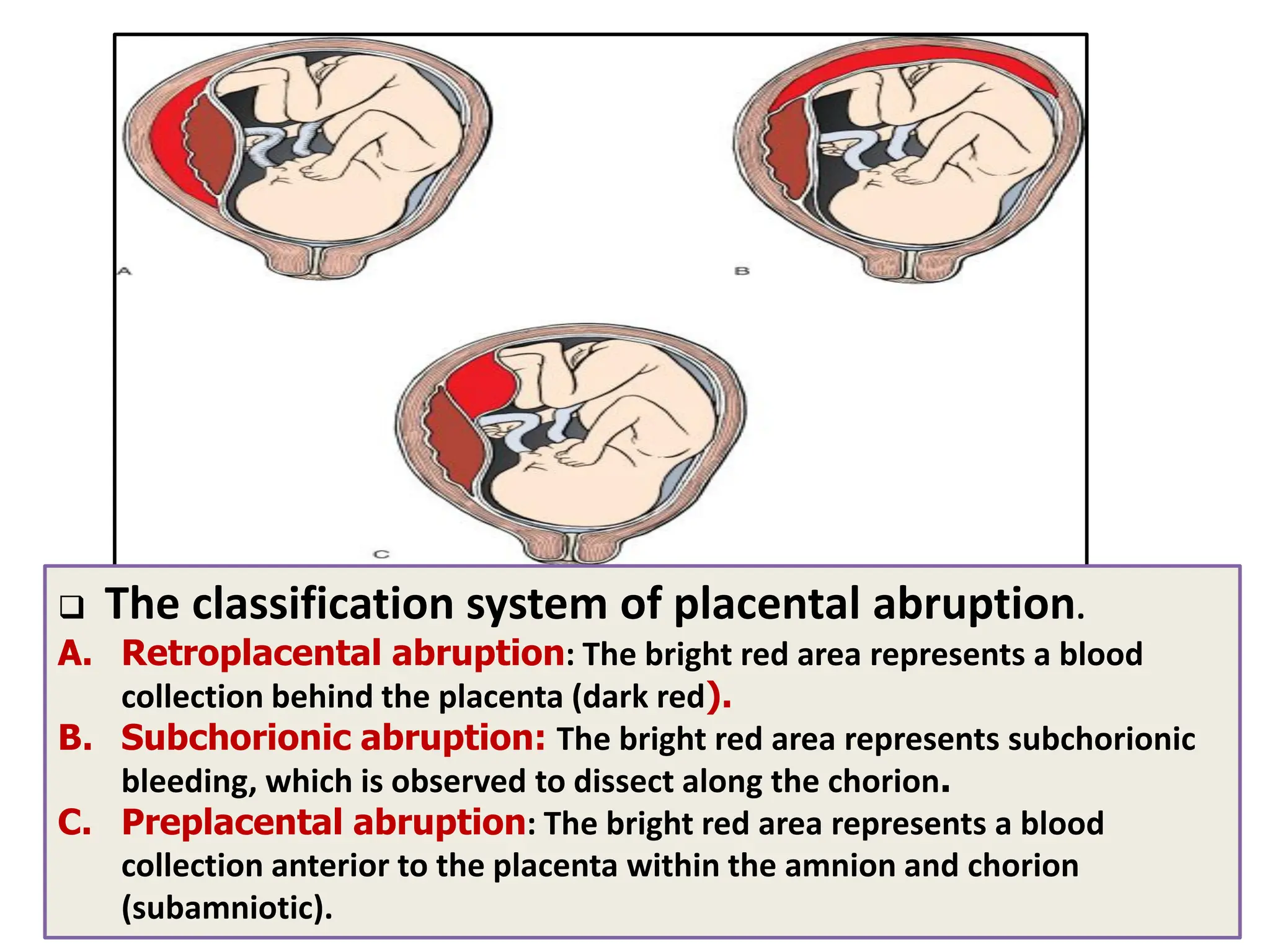 The classification system of placental abruption.
A. Retroplacental abruption: The bright red area represents a blood
collection behind the placenta (dark red).
B. Subchorionic abruption: The bright red area represents subchorionic
bleeding, which is observed to dissect along the chorion.
C. Preplacental abruption: The bright red area represents a blood
collection anterior to the placenta within the amnion and chorion
(subamniotic).
 