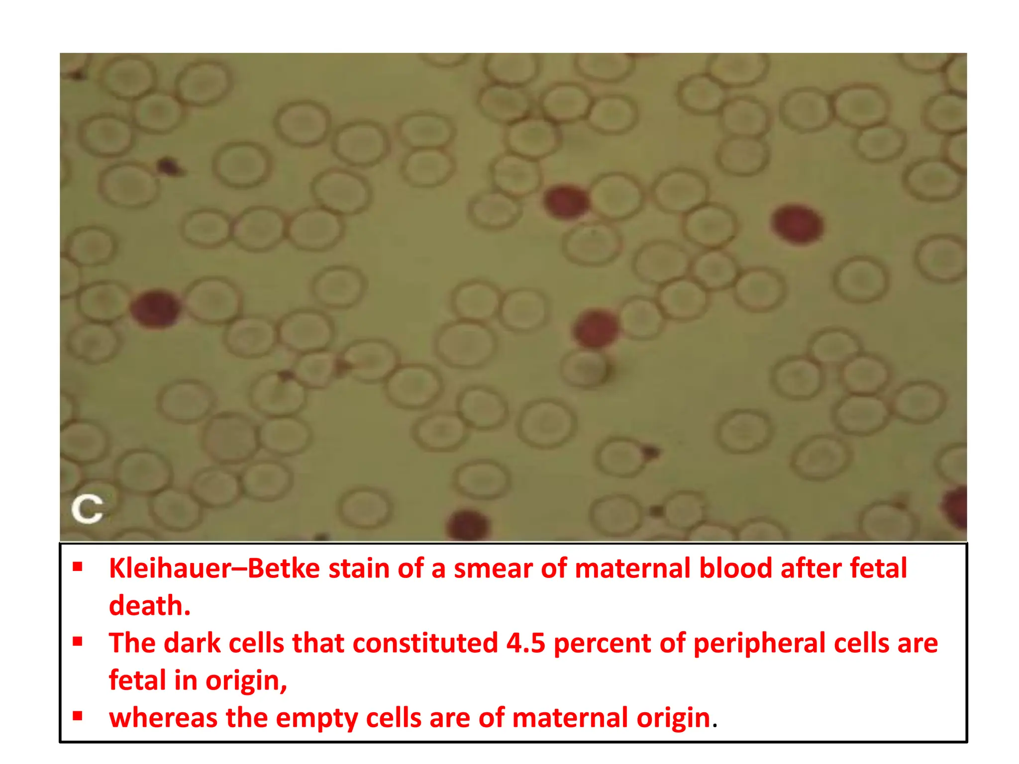  Kleihauer–Betke stain of a smear of maternal blood after fetal
death.
 The dark cells that constituted 4.5 percent of peripheral cells are
fetal in origin,
 whereas the empty cells are of maternal origin.
 