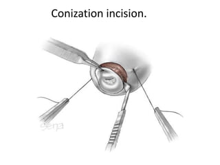Conization incision.
 