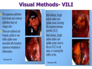 Visual Methods- VILI
 