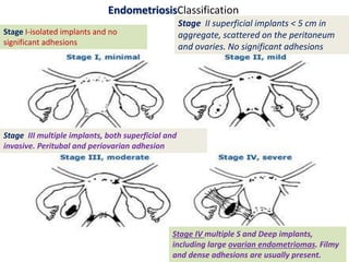 EndometriosisClassification
Stage I-isolated implants and no
significant adhesions
Stage II superficial implants < 5 cm in
aggregate, scattered on the peritoneum
and ovaries. No significant adhesions
Stage III multiple implants, both superficial and
invasive. Peritubal and periovarian adhesion
Stage IV multiple S and Deep implants,
including large ovarian endometriomas. Filmy
and dense adhesions are usually present.
 