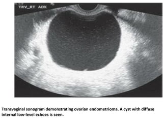 Transvaginal sonogram demonstrating ovarian endometrioma. A cyst with diffuse
internal low-level echoes is seen.
 